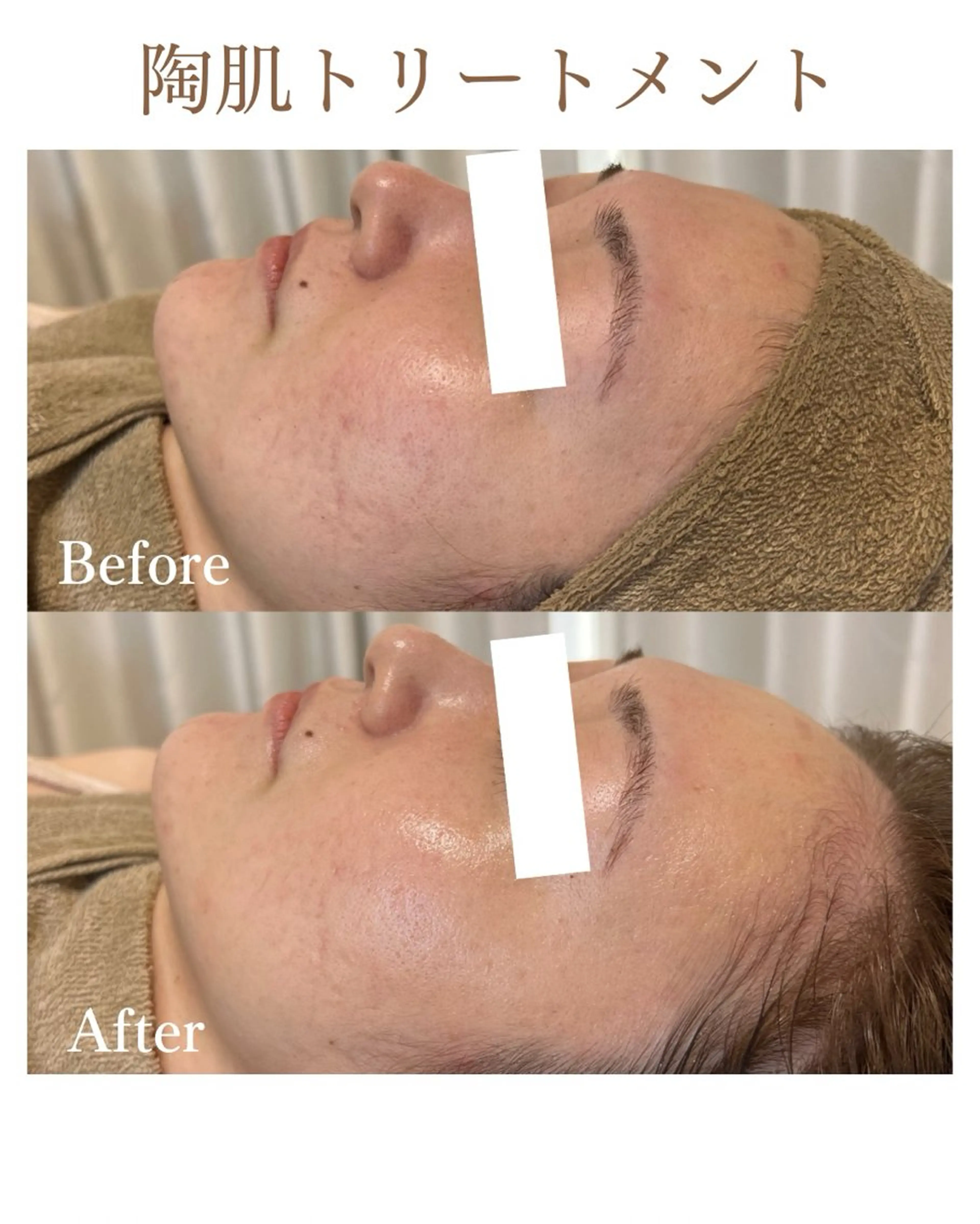 【初回お試し】REVIハーブピーリング🌿の写真