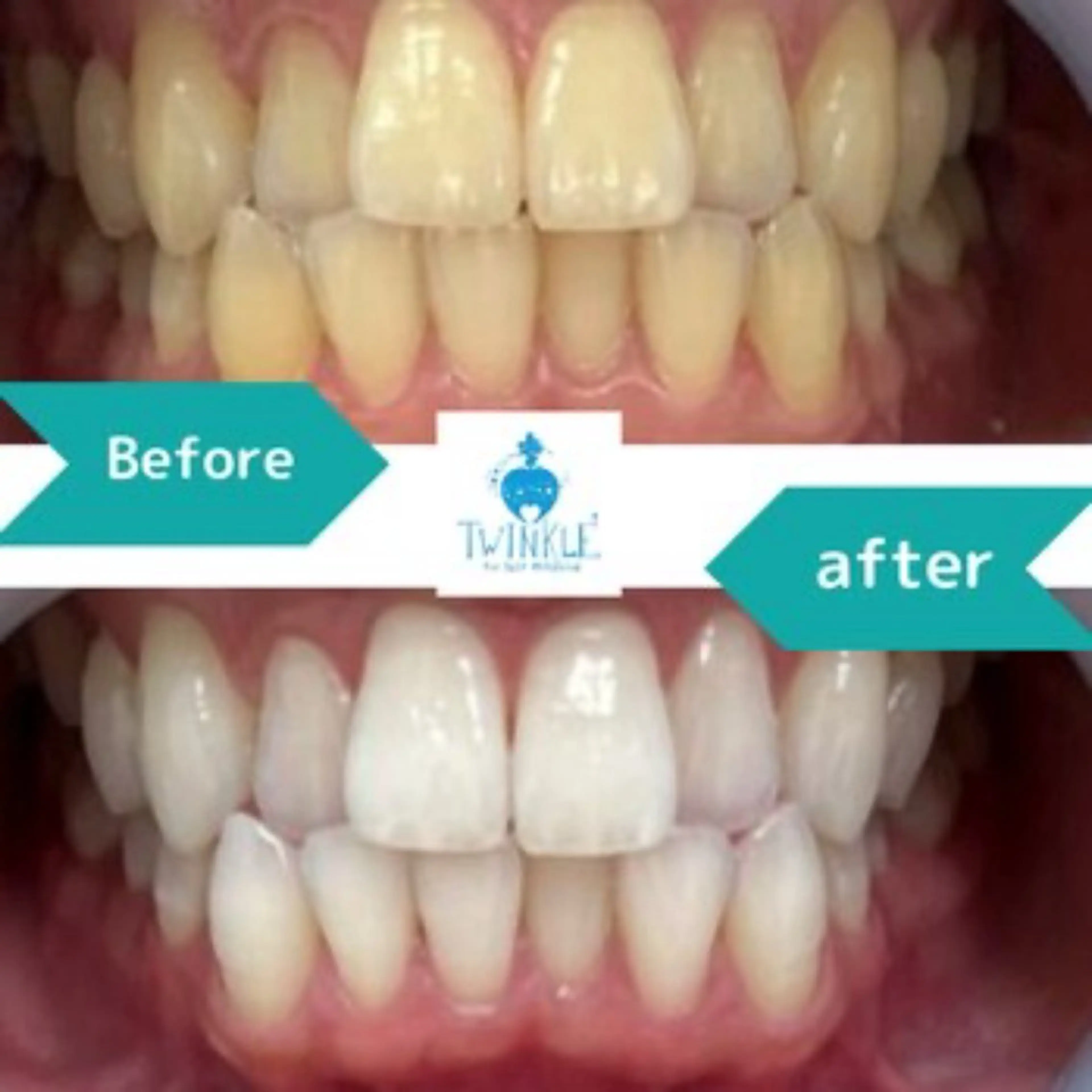 【ミニ集中コース🌟】ミニ１日ホワイトニング。8分照射×8回。人気の1日完結セルフホワイトニングのショートプラン。の写真