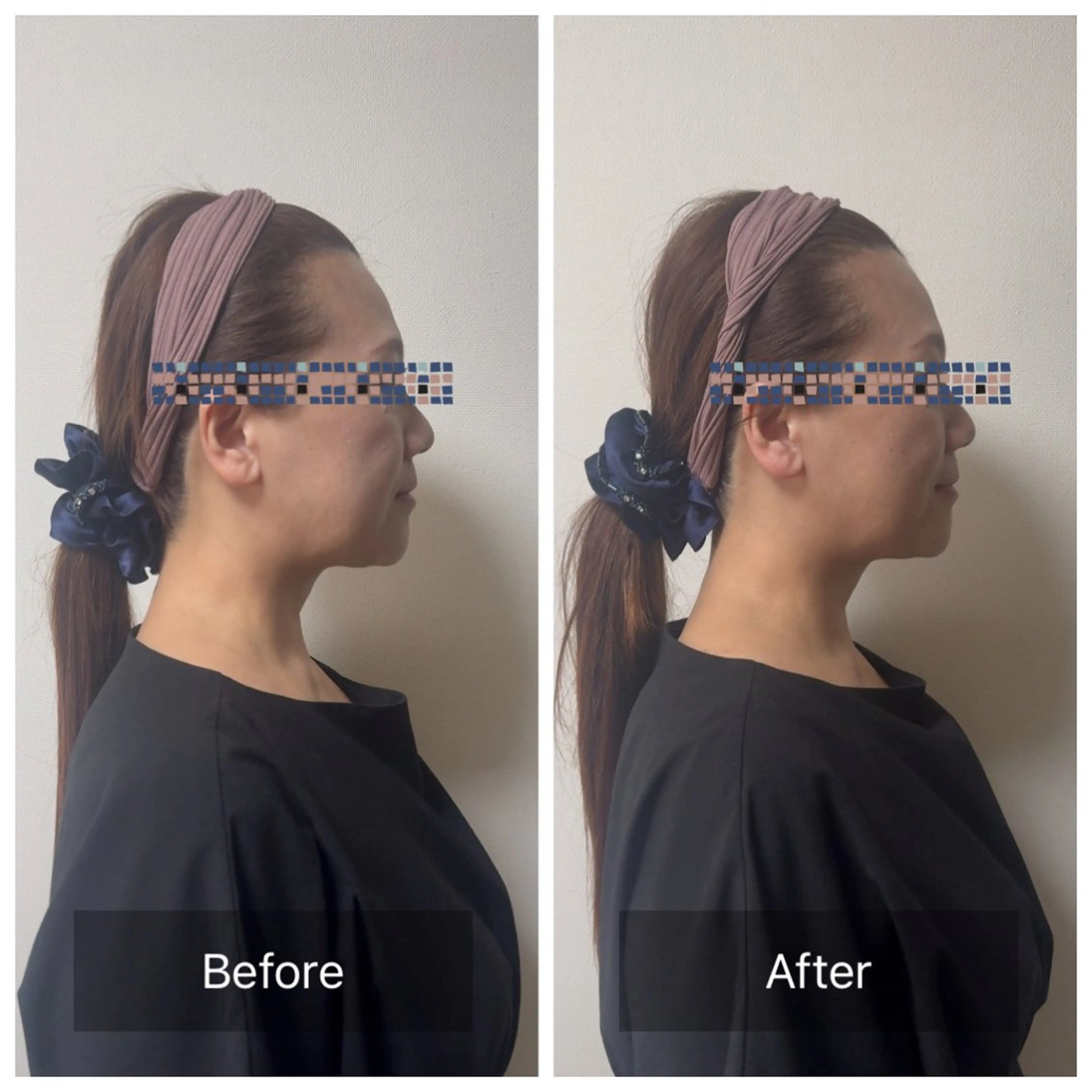 エイジング小顔リフトの写真