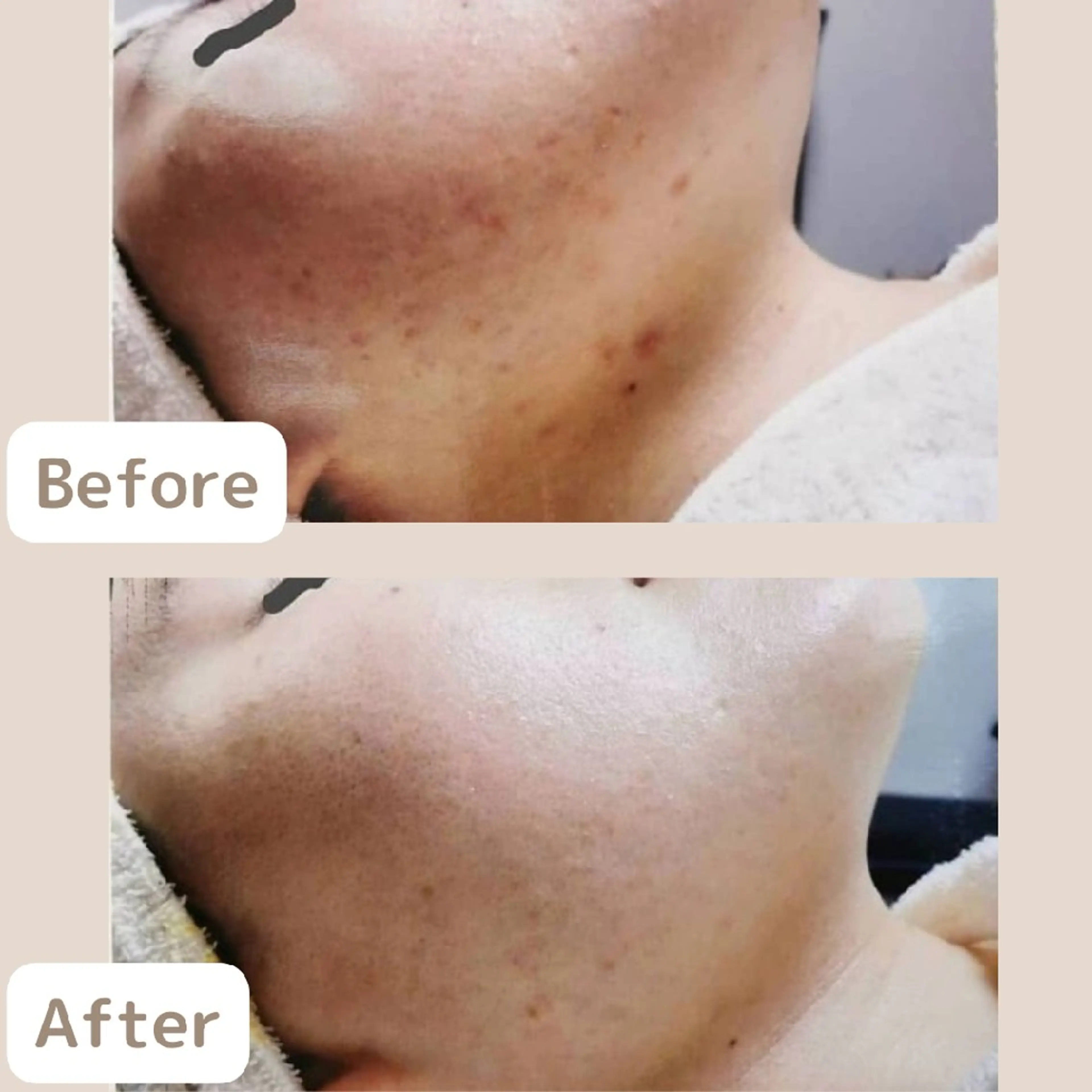 レチノール/ニキビ/ 毛穴ケア 浅川のエステ・リラクイメージ