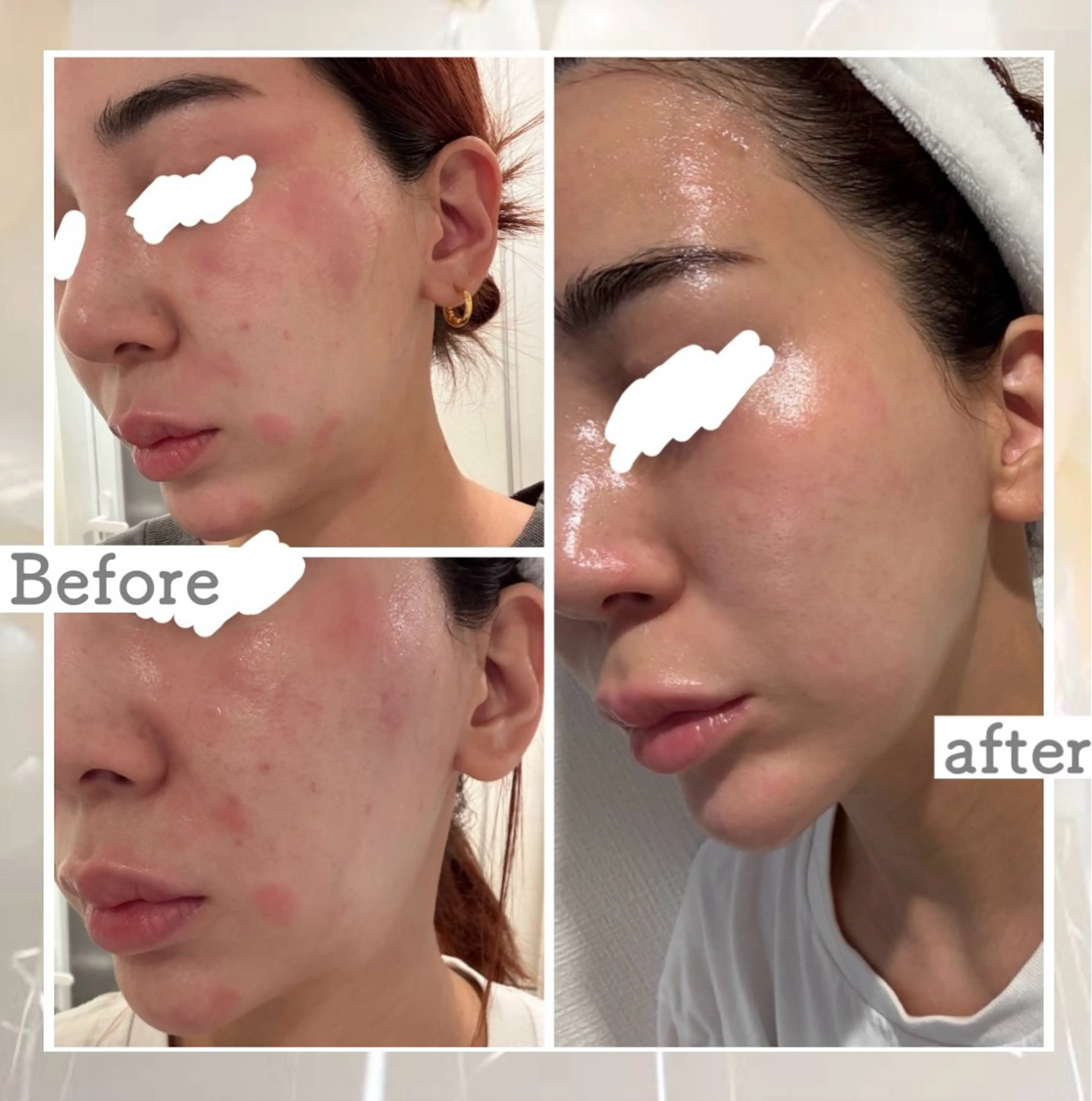 エステ ニキビ&跡改善サロン オーナー光木のエステ・リラクイメージ