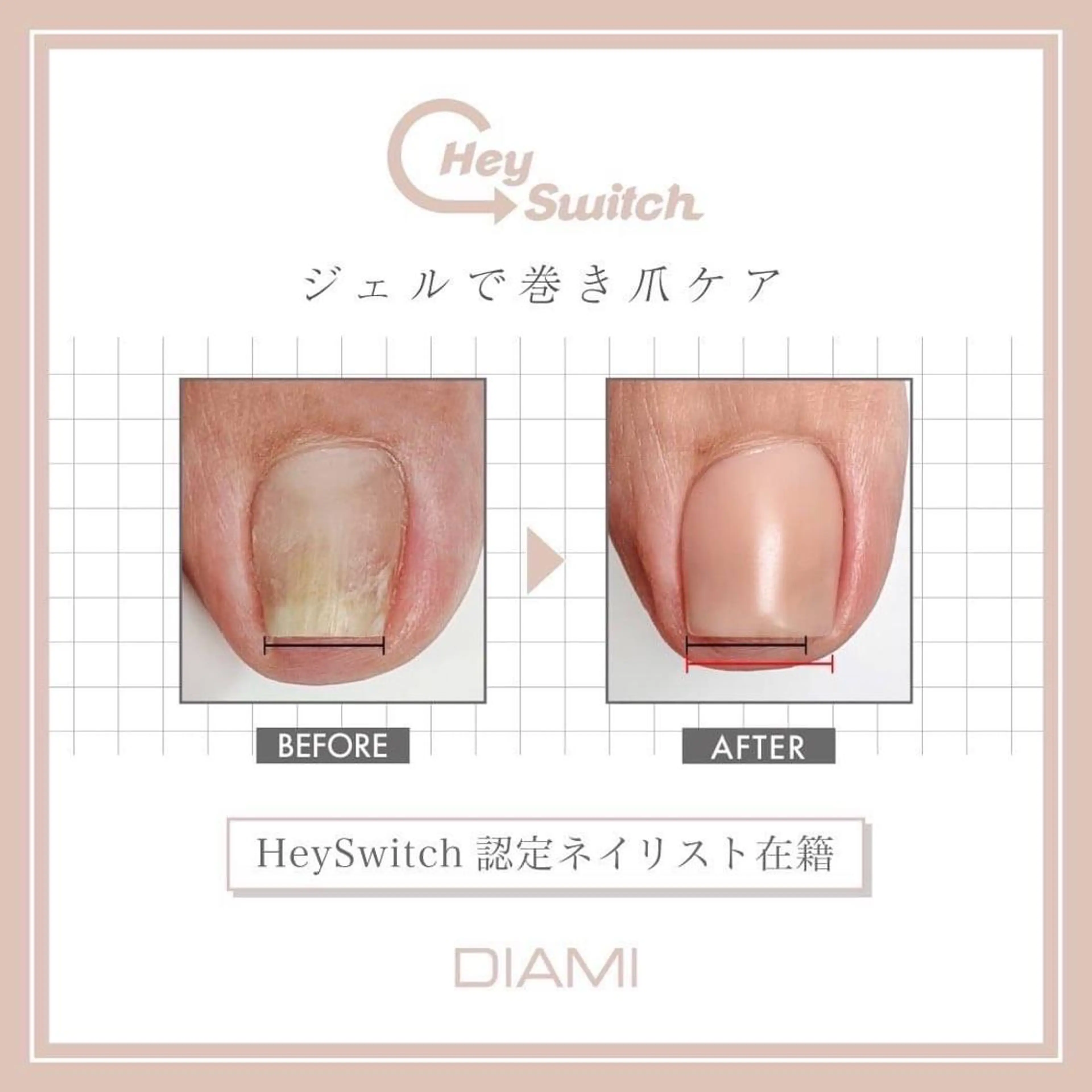 【HeySwitch導入★】韓国発の巻き爪ケアジェル🎵親指1本¥4.400、他の指1本¥2.200の写真