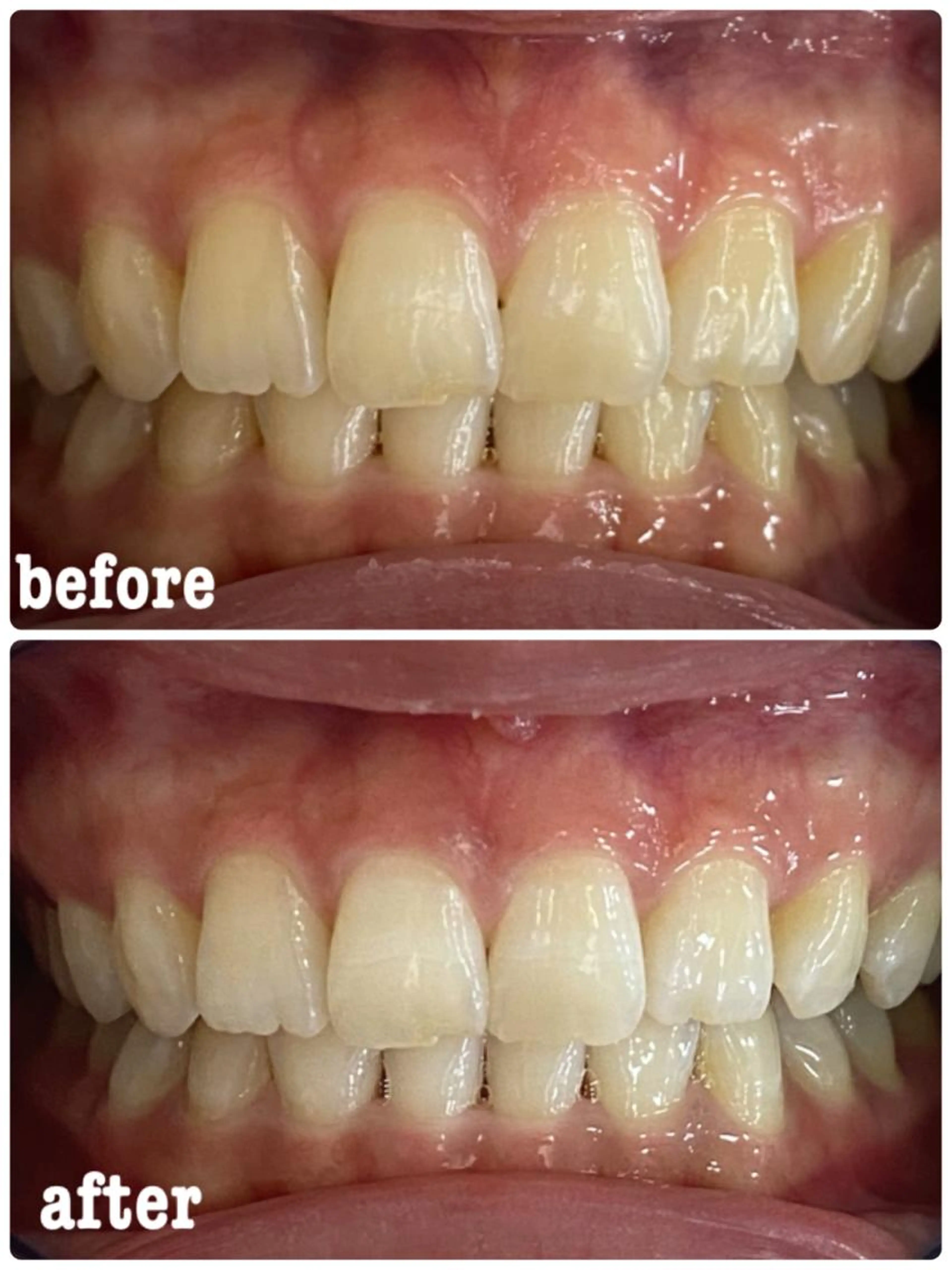 15分照射🦷✨の写真