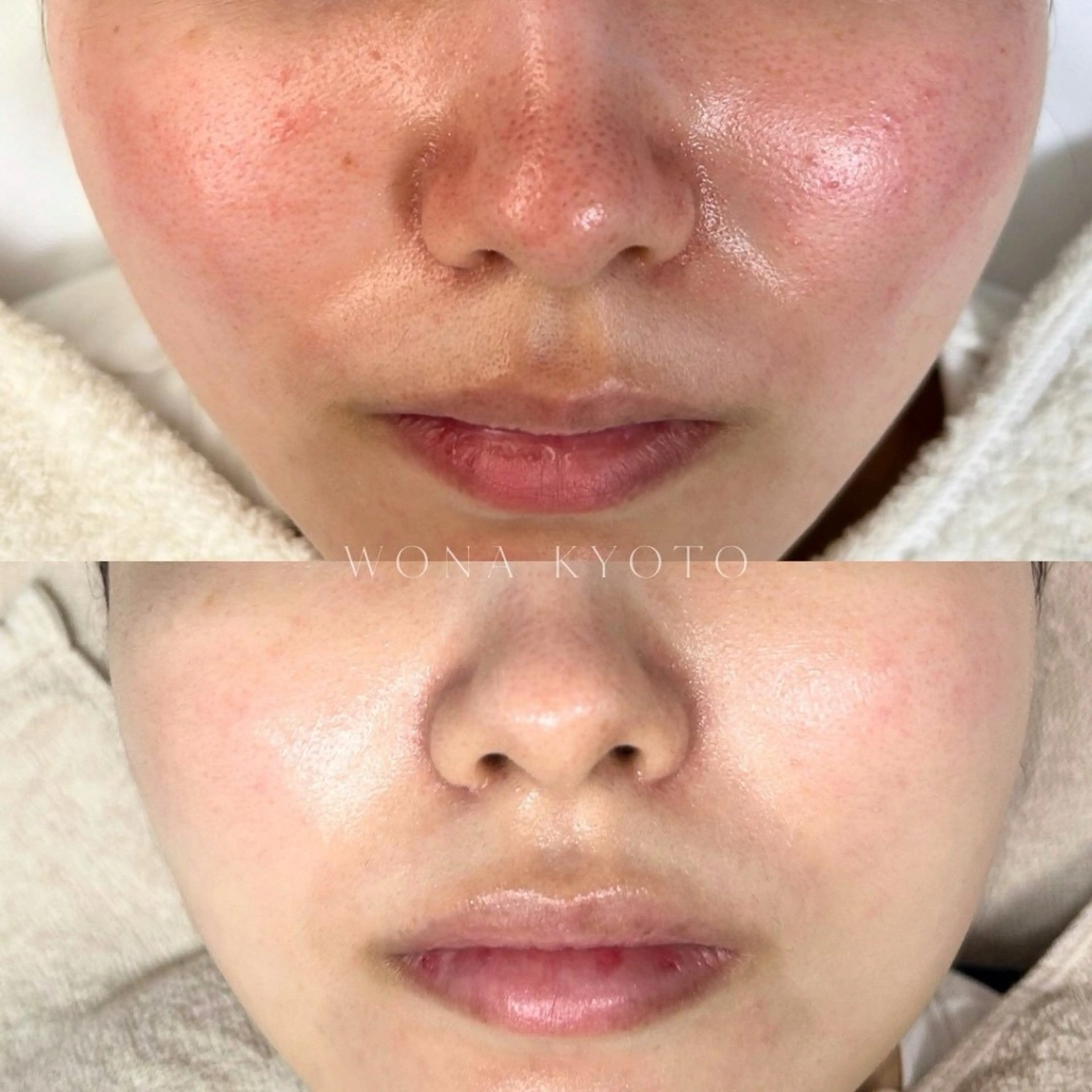 【乾燥ゴワつき/水分管理】毛穴レスぷるぷる透明感！潤いに満ちた健やかな水光肌へ◎アクアピール＋ヒアロテン管理の写真