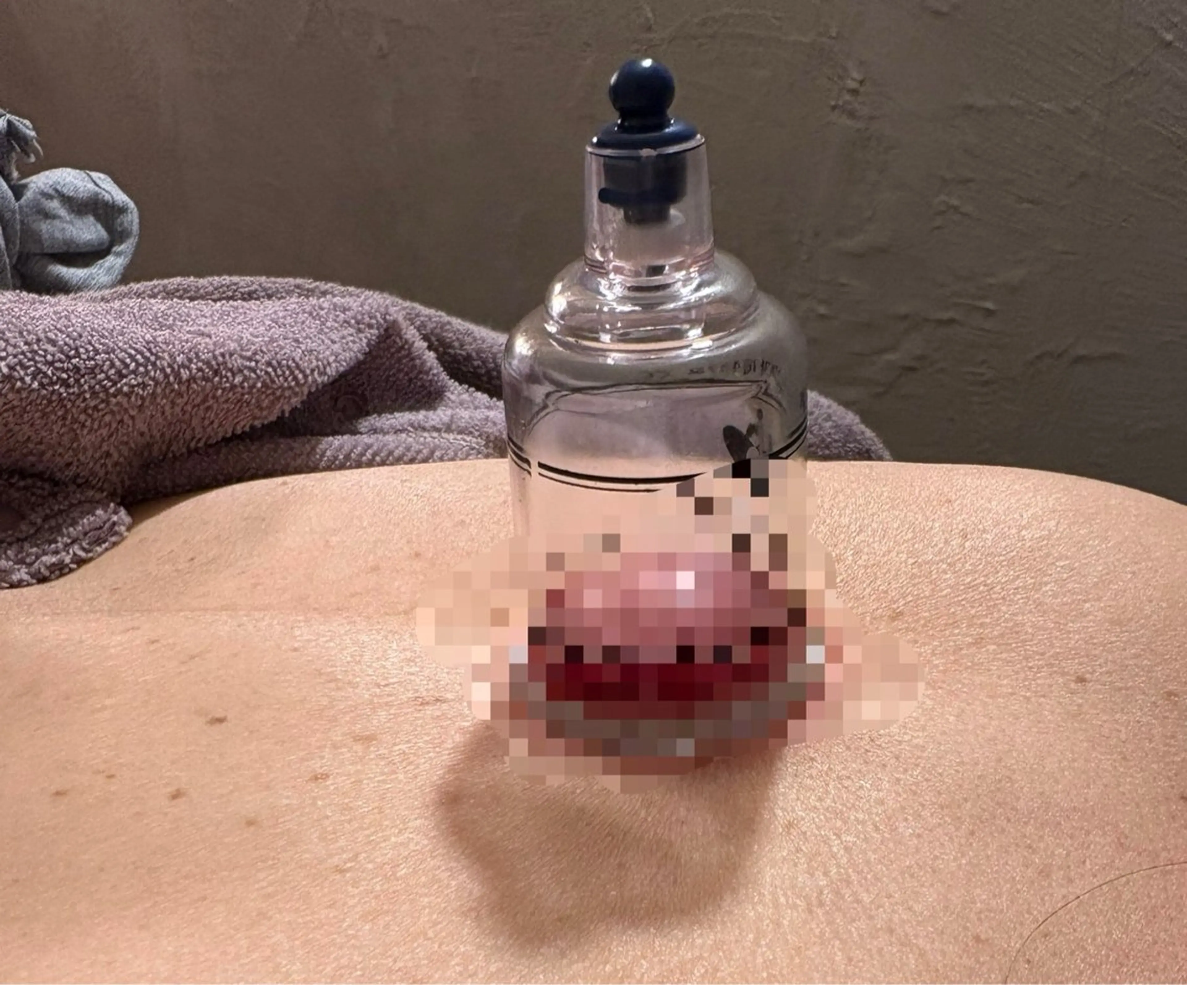 デトックスカッピング全身鍼灸の写真