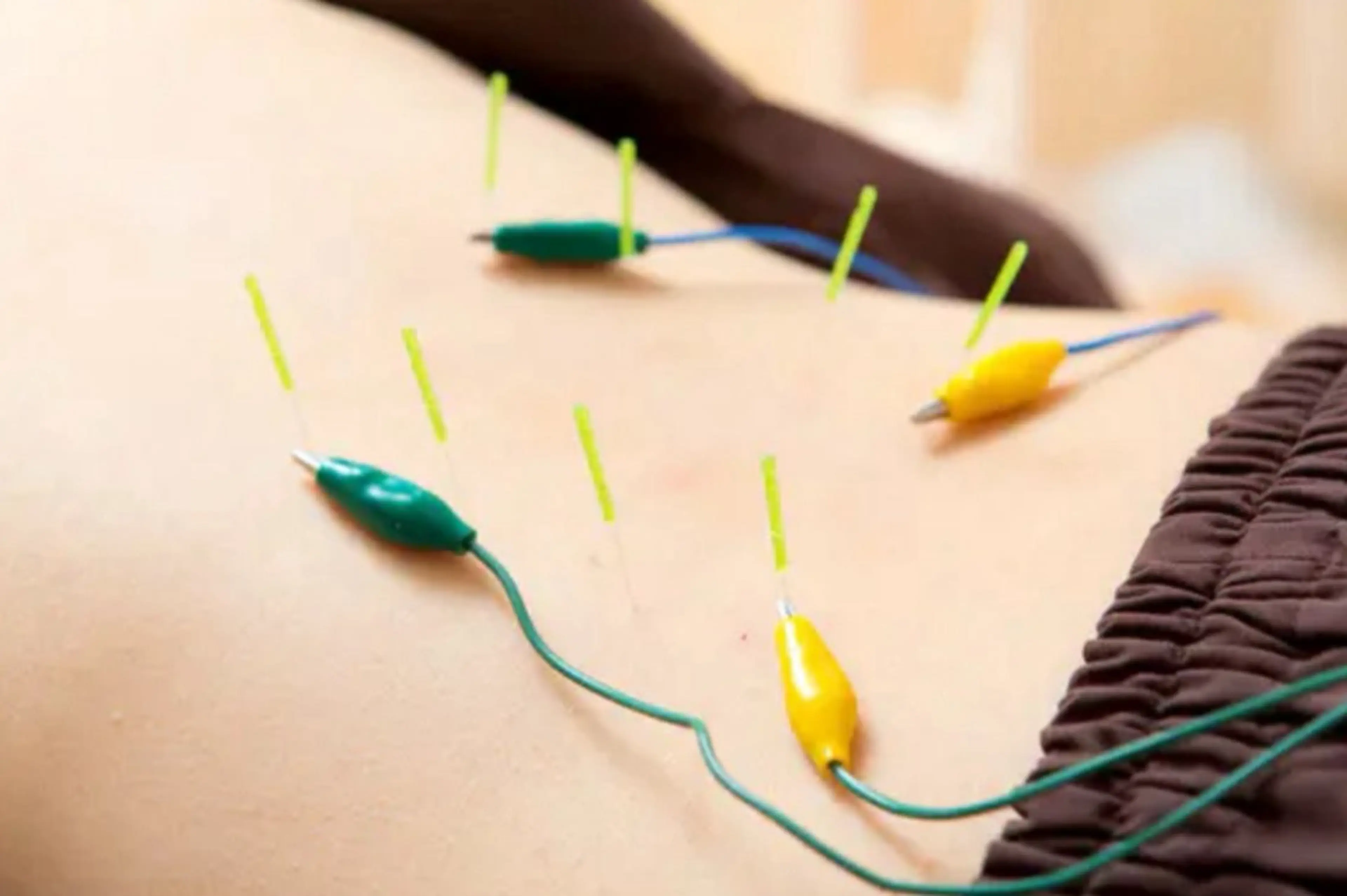 頑固な腰痛撃退✨鍼通電施術✨の写真