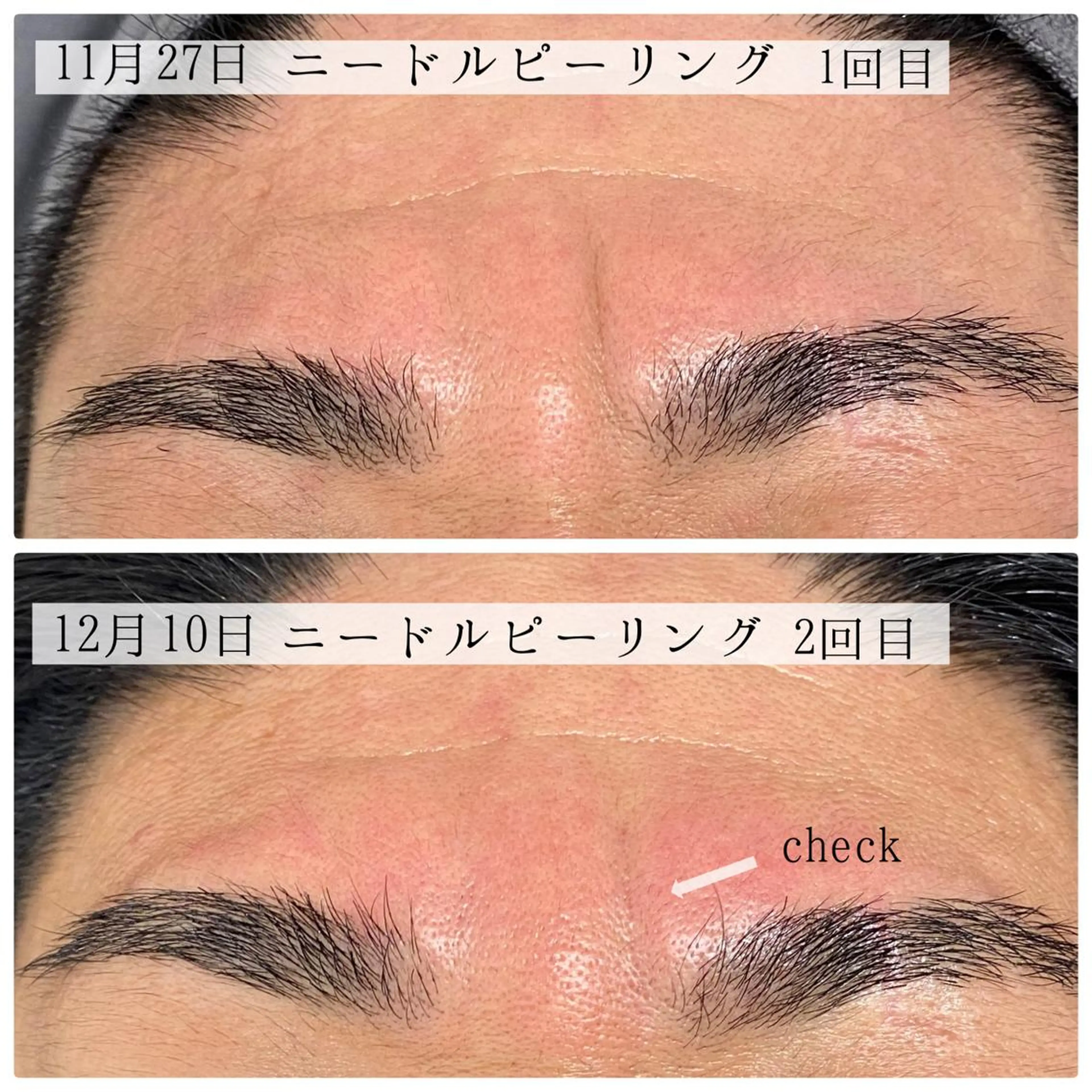 ニキビ特化美容鍼 ×ハーブピーリングのエステ・リラクイメージ