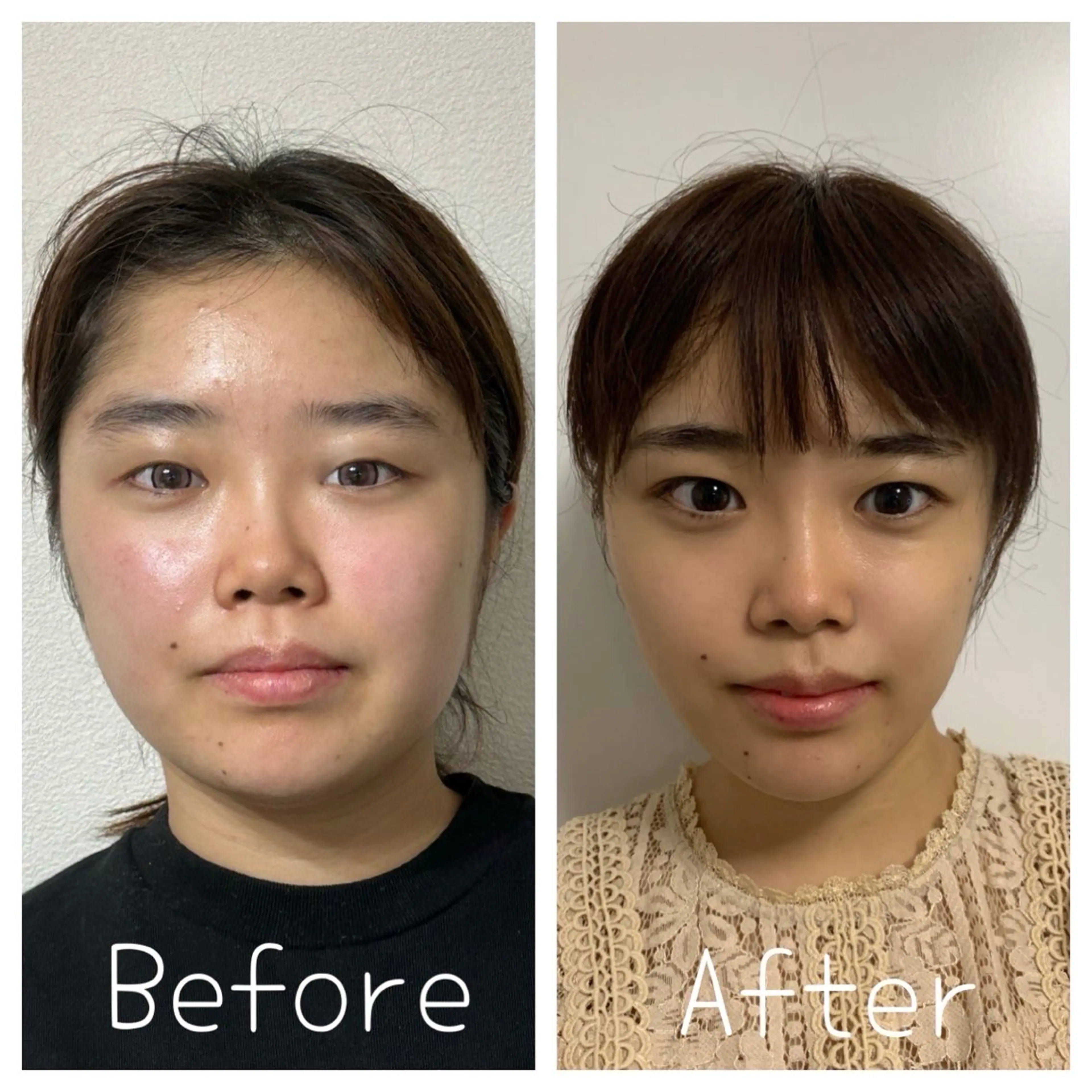 1番人気🔥小顔矯正×はいふ『小顔／リフトアップ／むくみ／ゆがみ／エラ張り』の写真