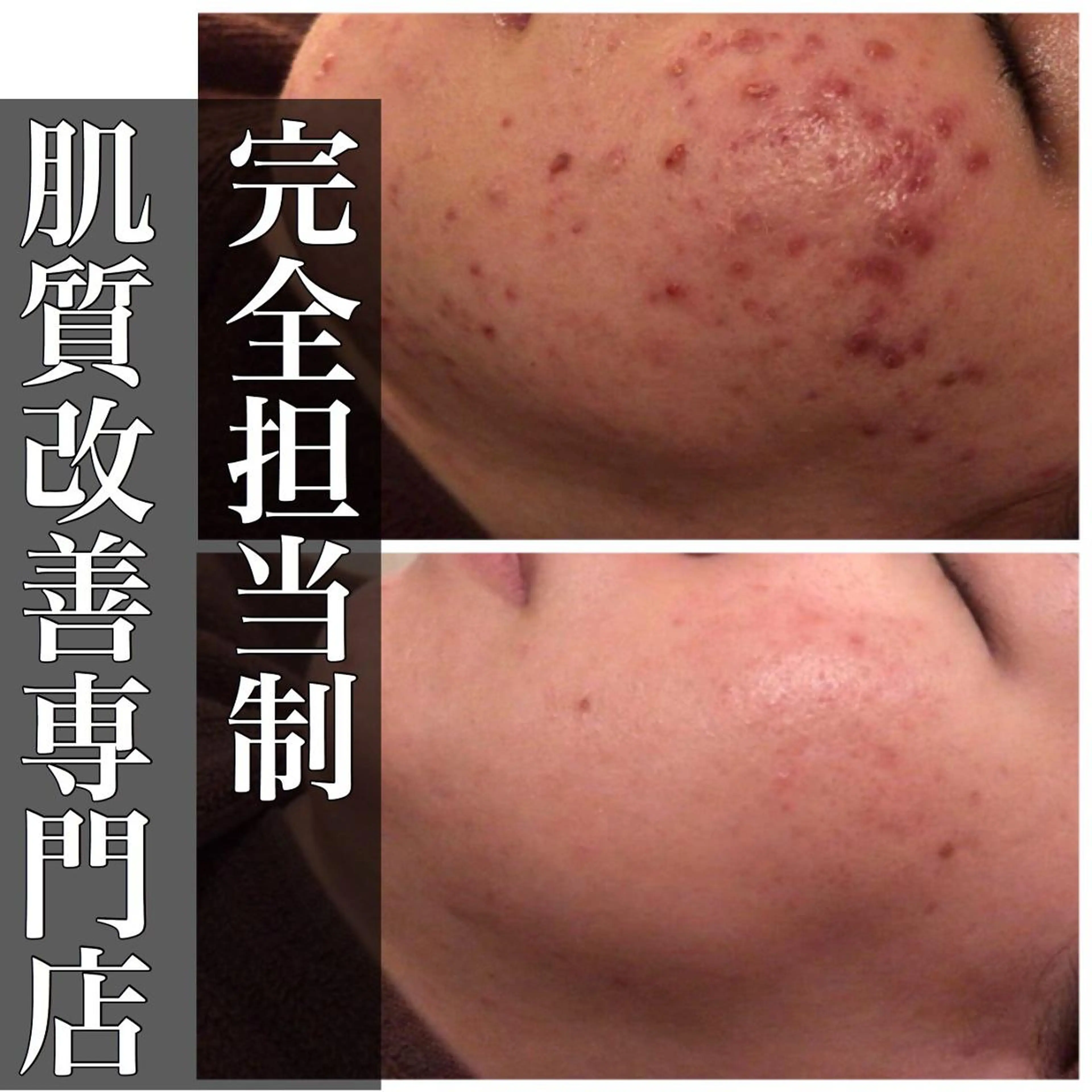 🔥3か月で肌革命 🔥ニキビ専門店のエステ・リラクイメージ
