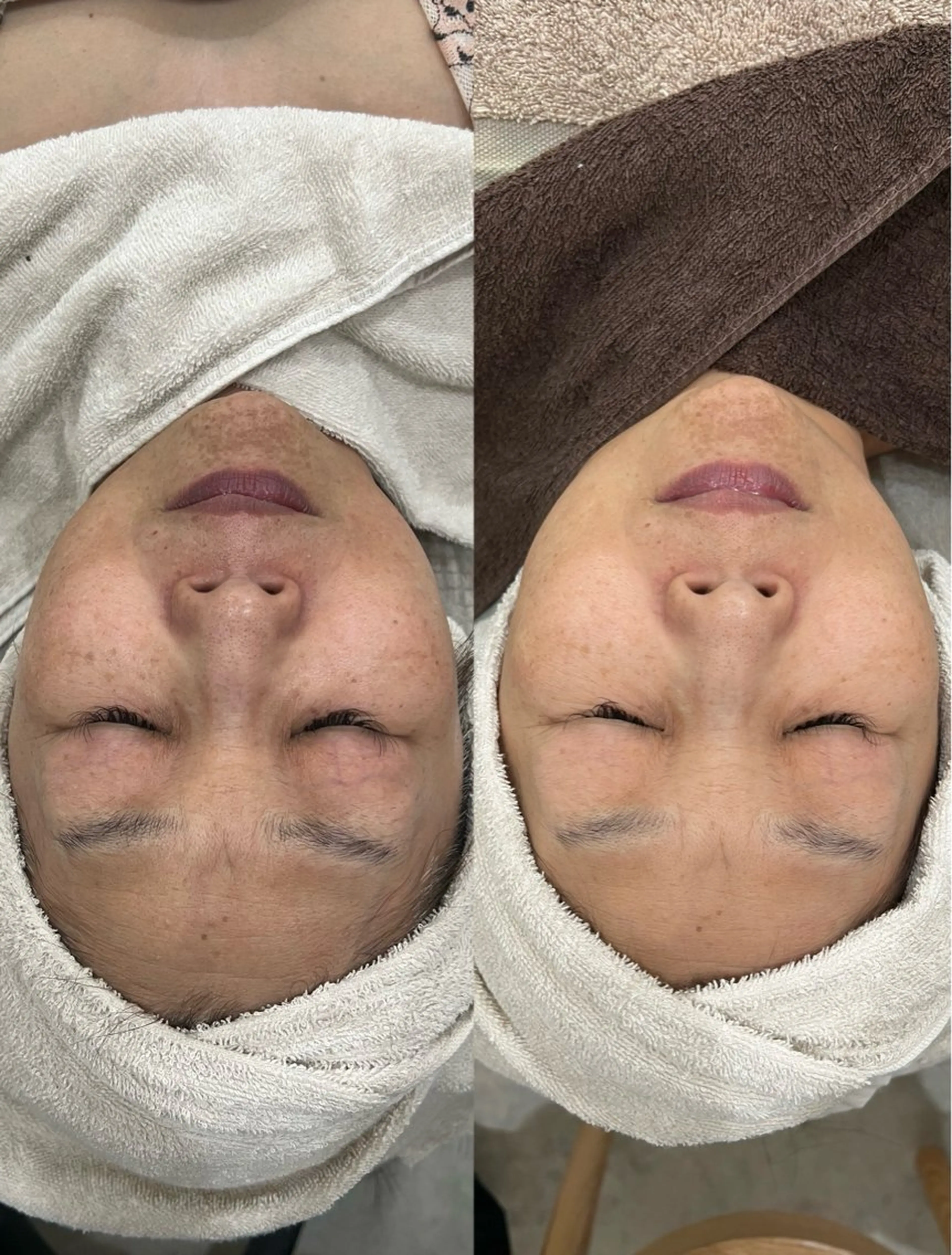 【高知初施術】ファンデーションいらず！メソスキンカラー🌈の写真