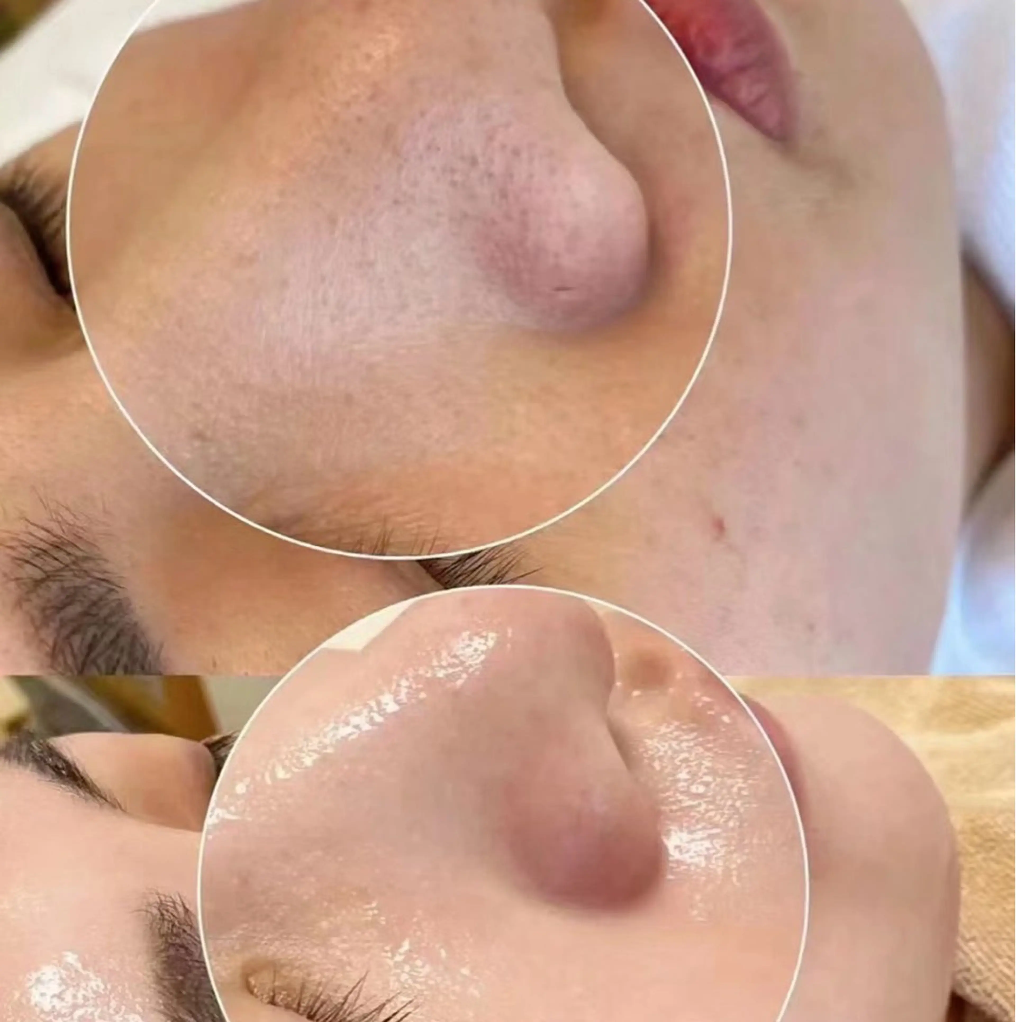 毛穴洗浄&フェイシャルコースの写真