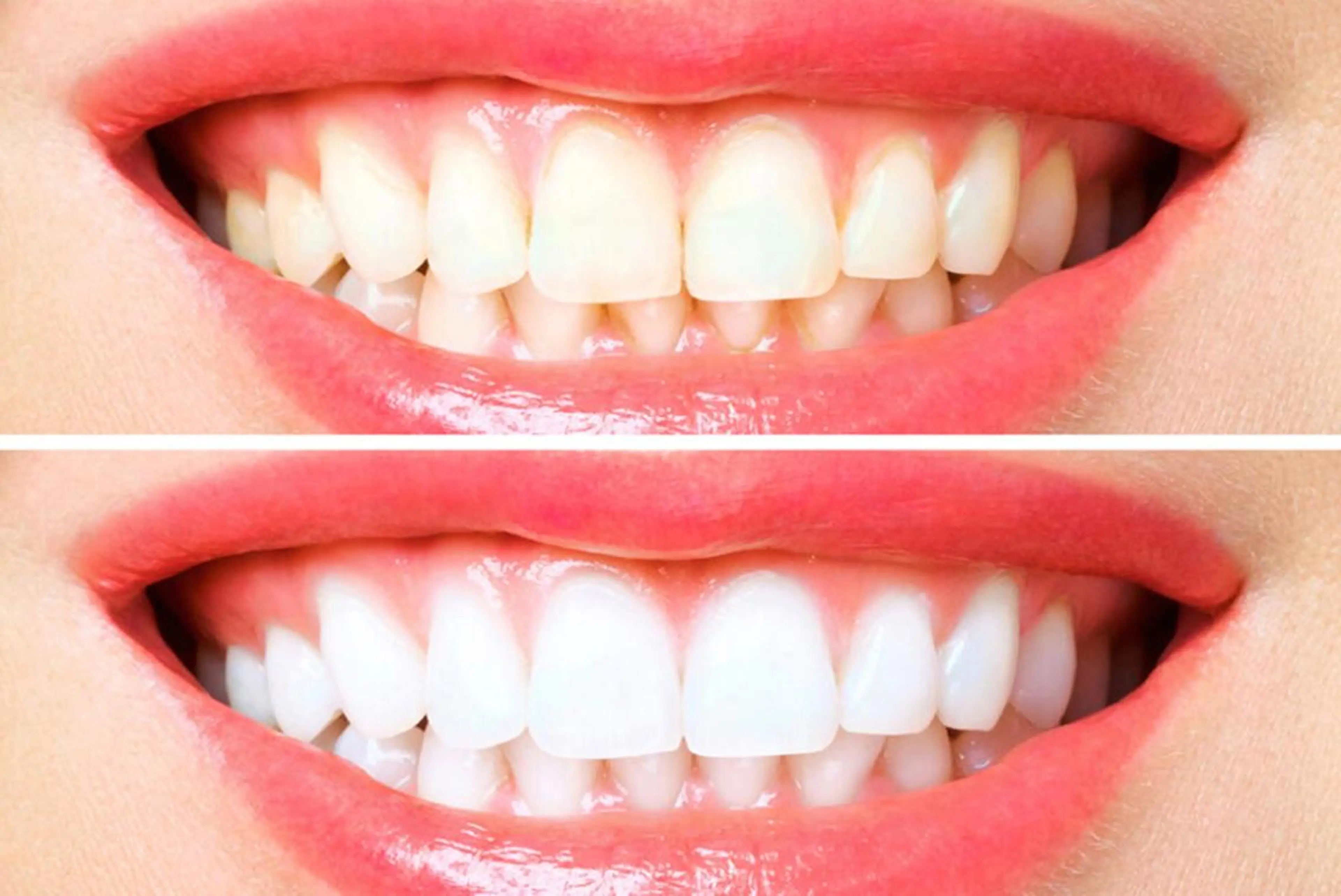 🦷1ヶ月通い放題🦷歯エステホワイトニング1回20分照射🫧モデルさん多数ご利用😳💕の写真