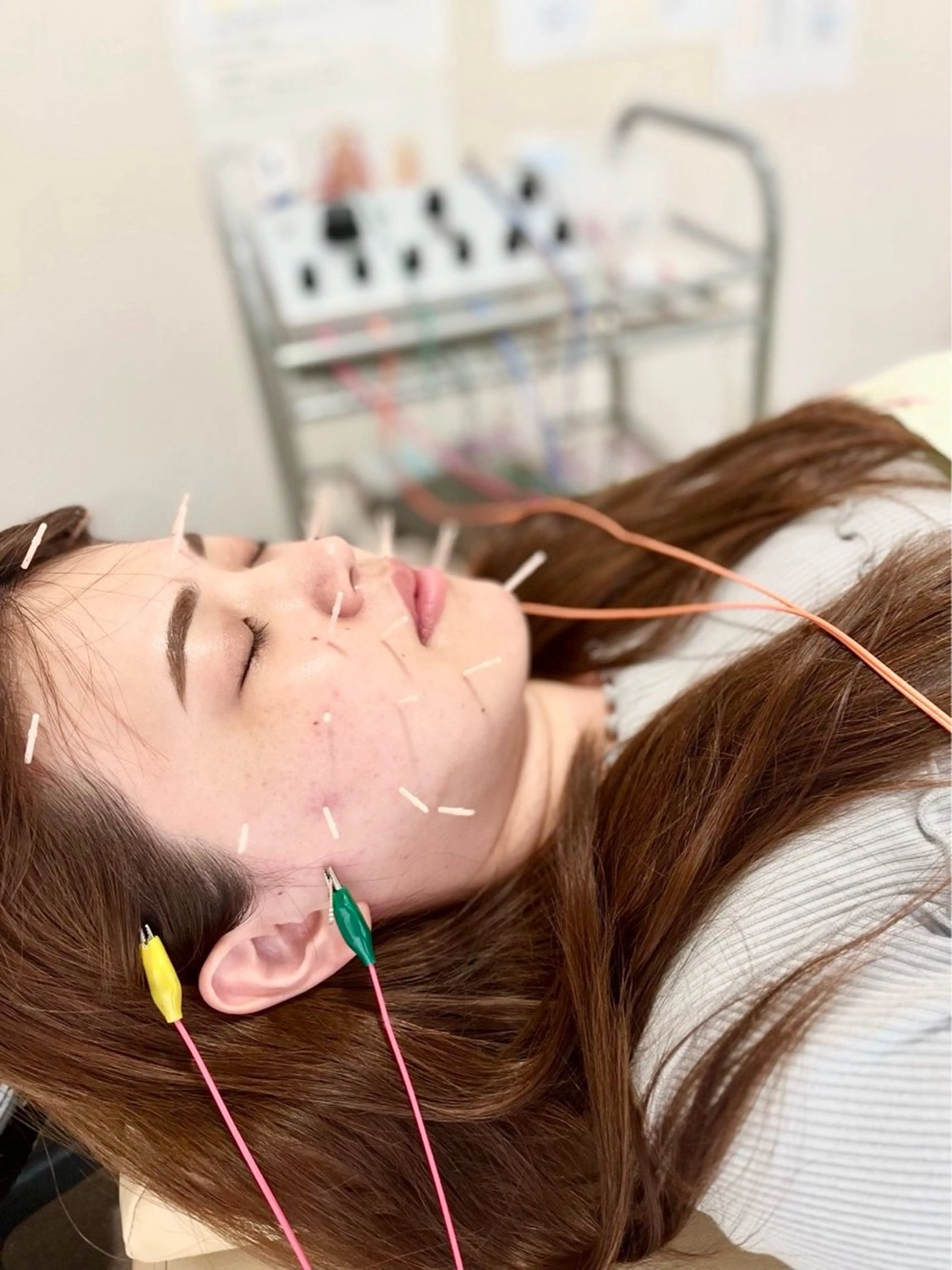 その他 リフトアップ・たるみ ☆美容鍼小顔矯正のその他イメージ