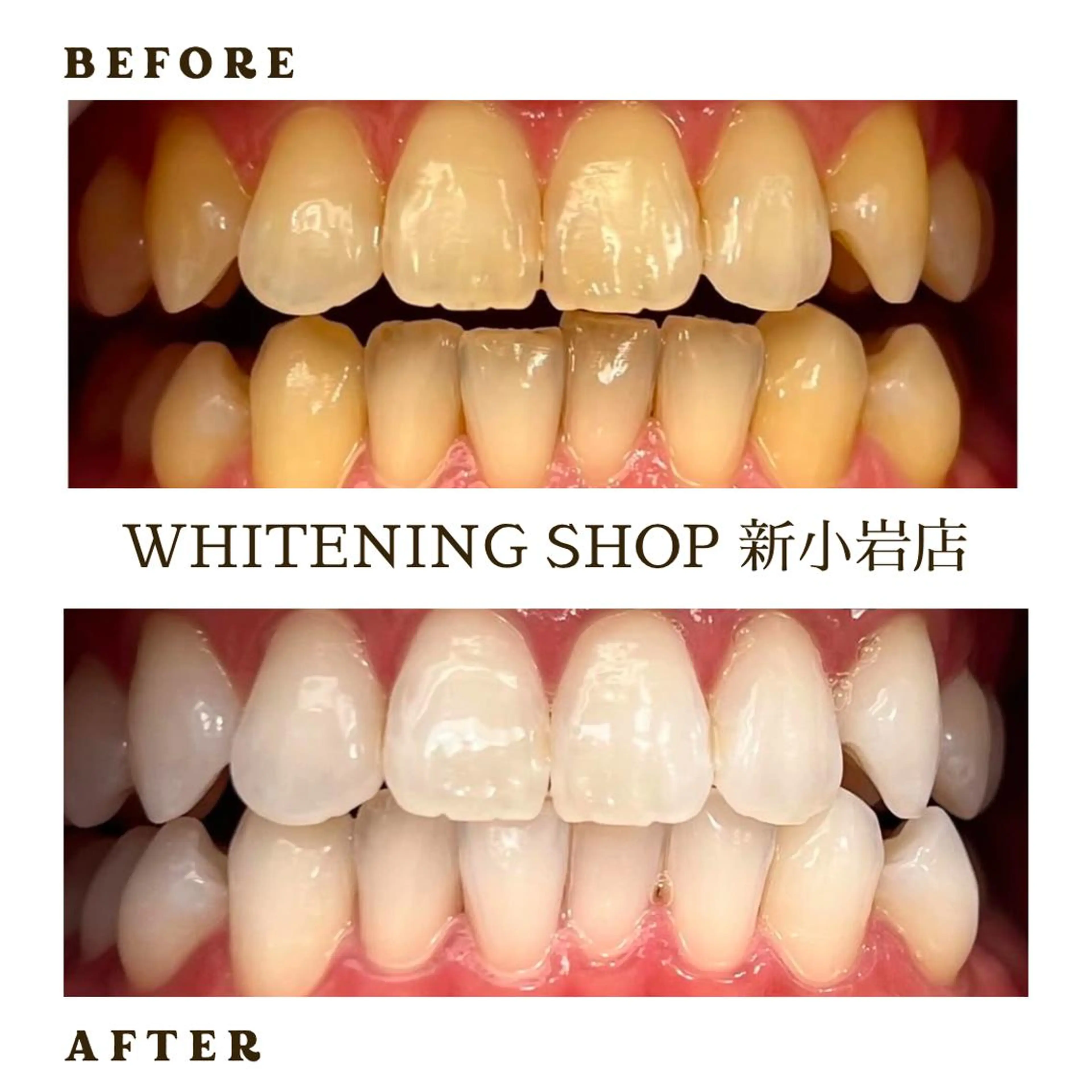 【U24ホワイトニング】🌸20分×6回照射🌸の写真