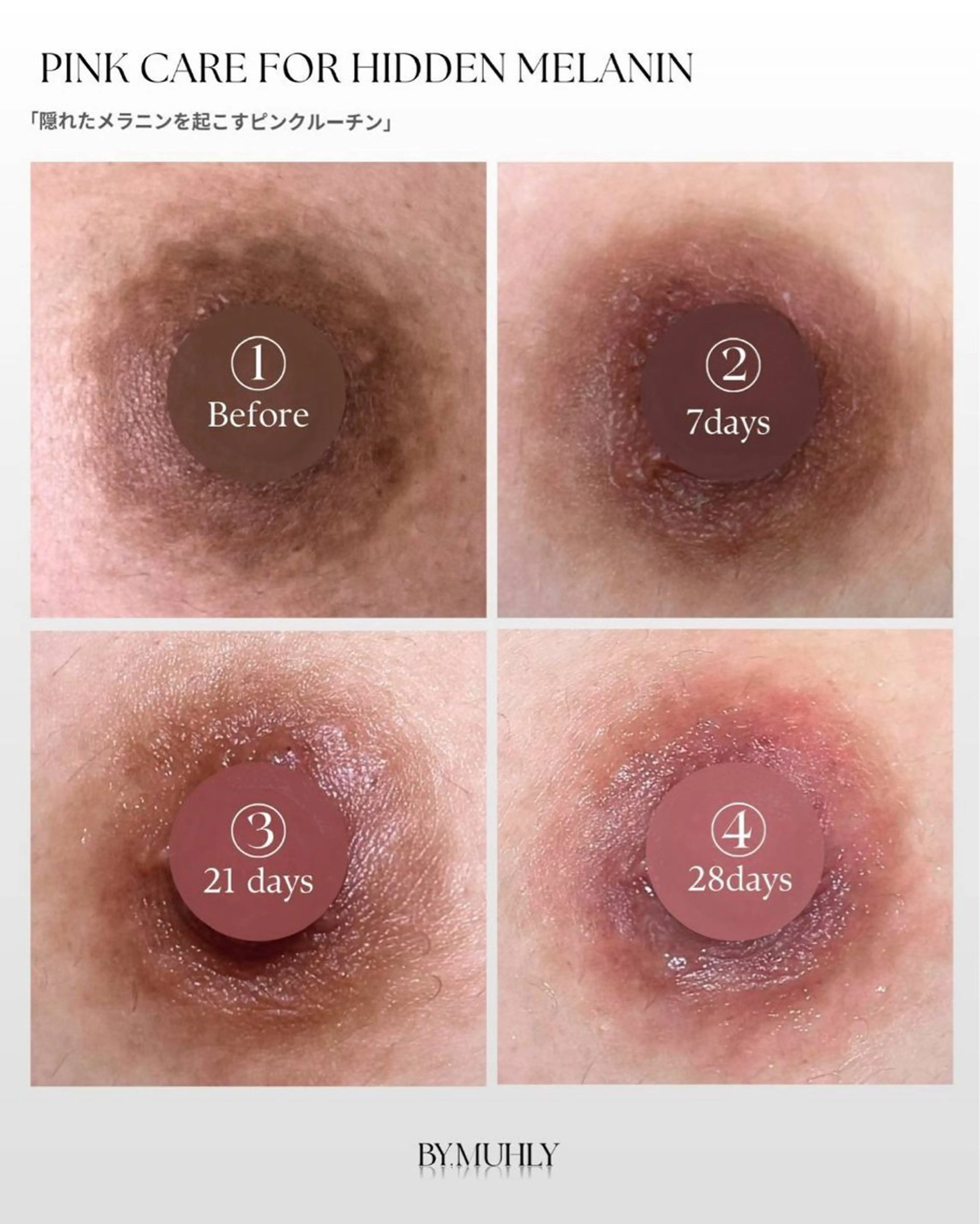 🎀💕モニター募集💕🎀💕baby pink乳輪💕🎀💕バイミュリー黒ずみメラニン除去💕🎀補足必読の写真