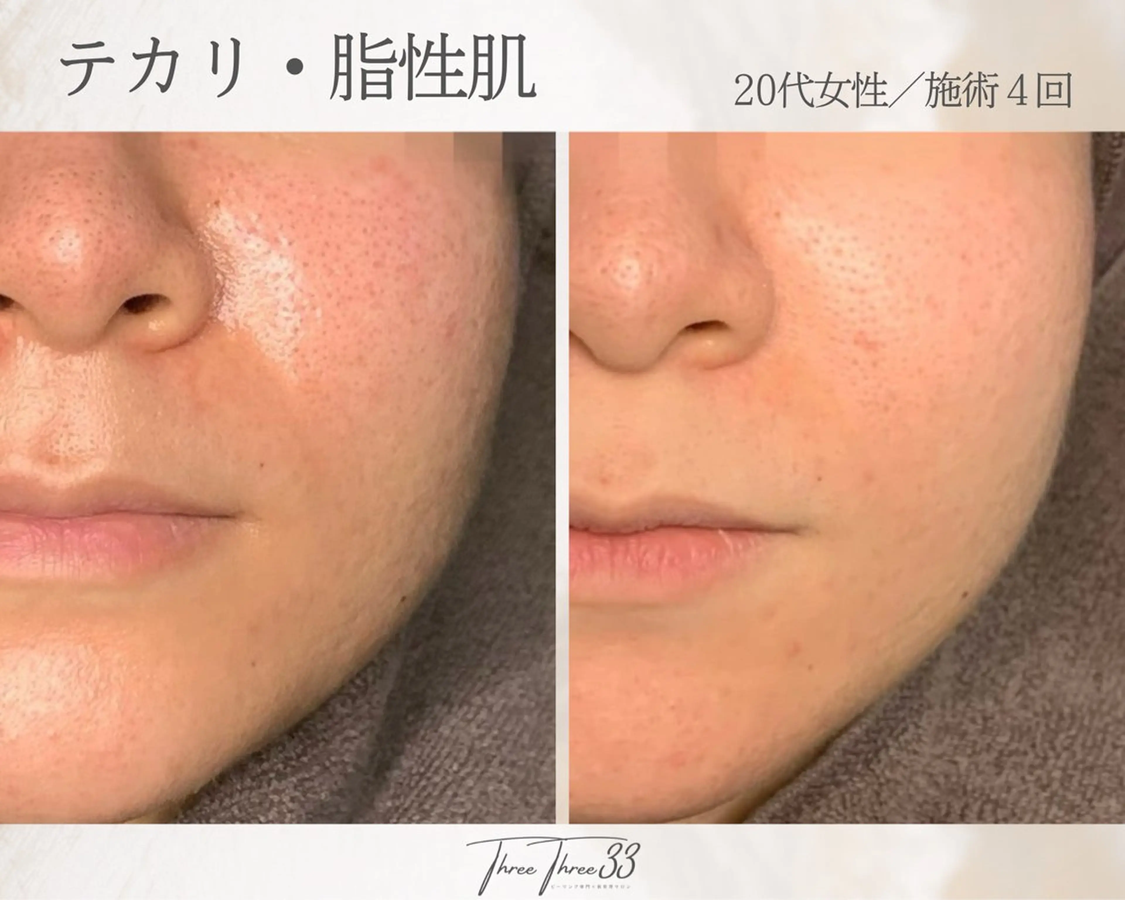 エステ ピーリング×肌管理 THREETHREEのエステ・リラクイメージ