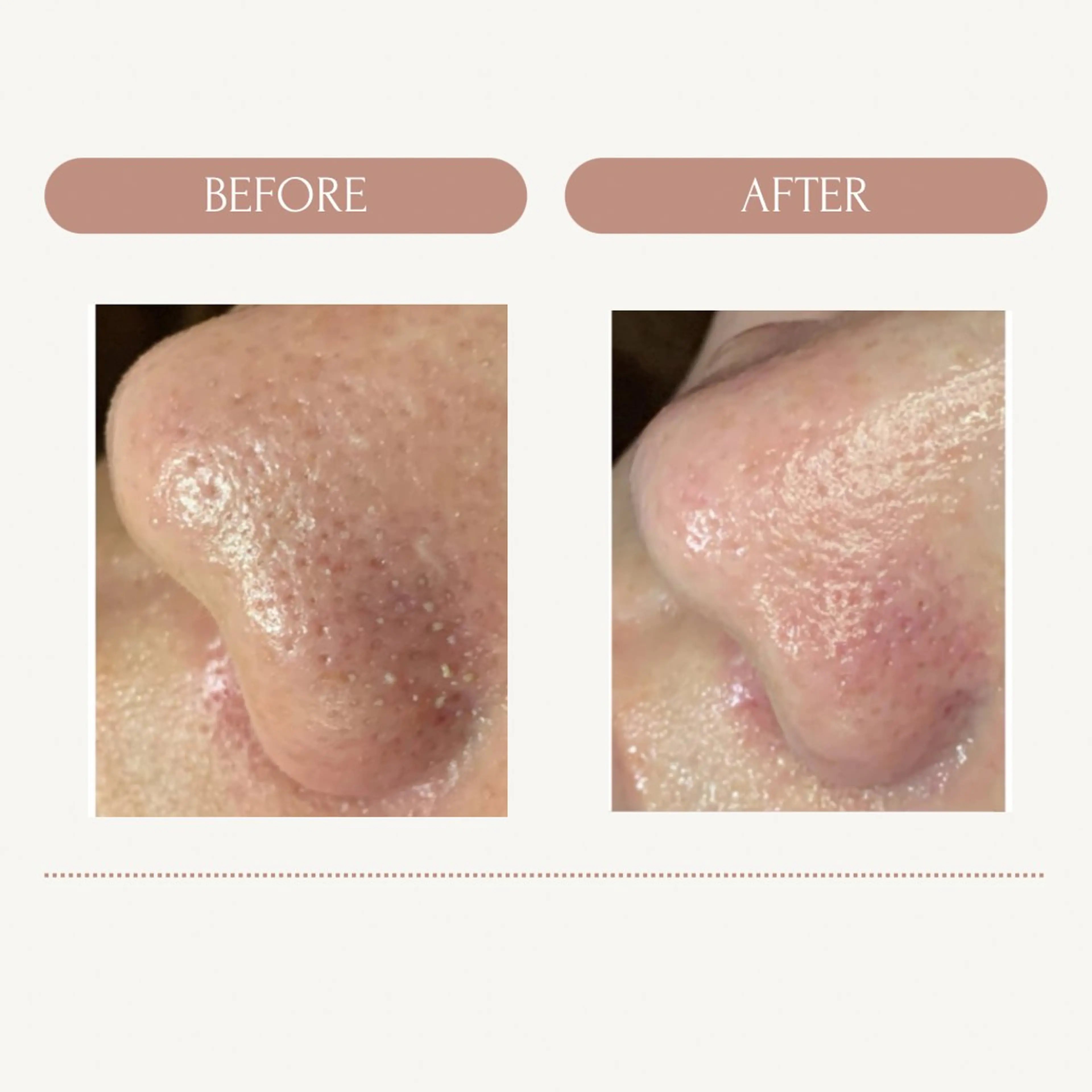 毛穴撃退💥ツルツル👃🏻美人✨の写真