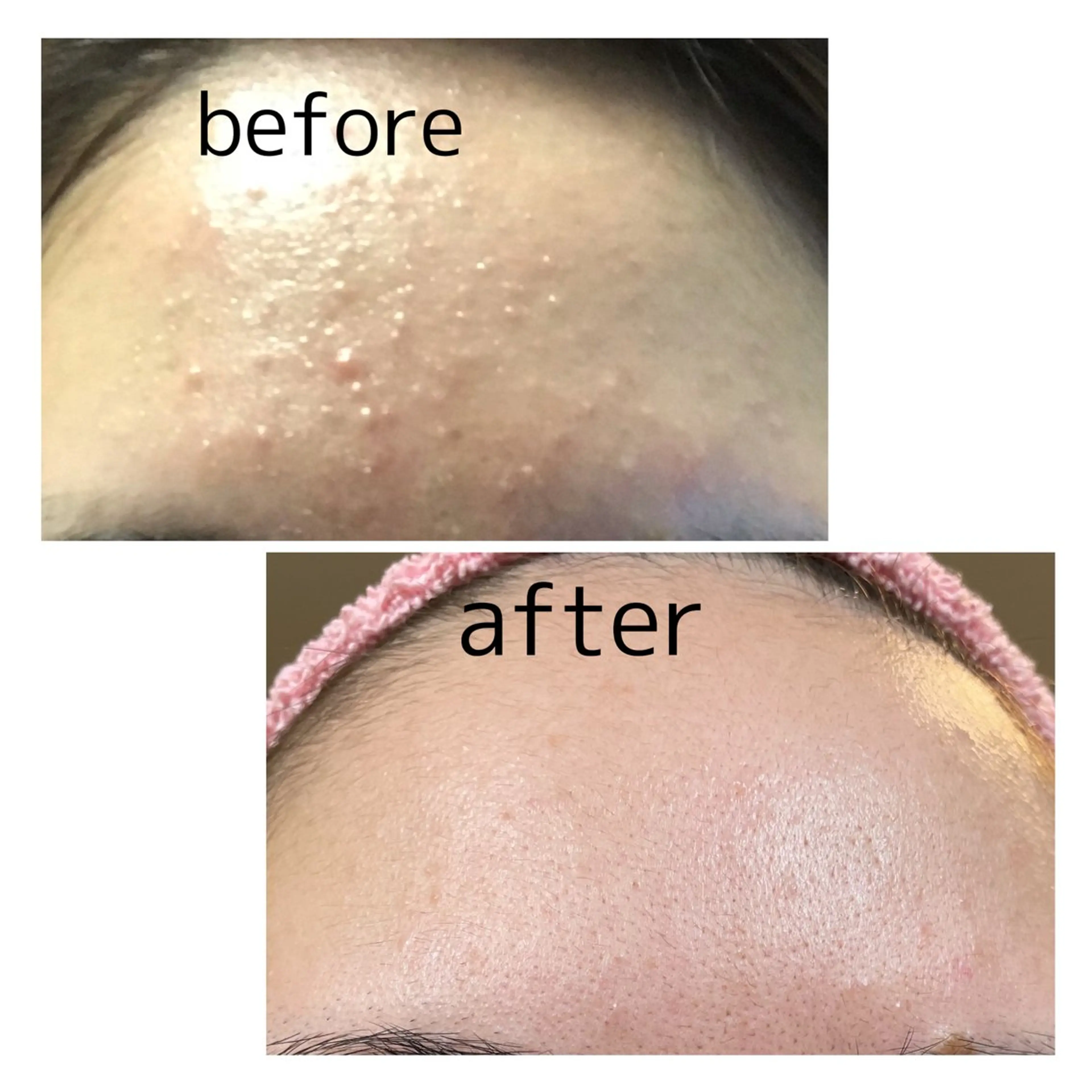 【本気の肌管理】リフトアップ＋イオン導入▼肌質分析込みの写真