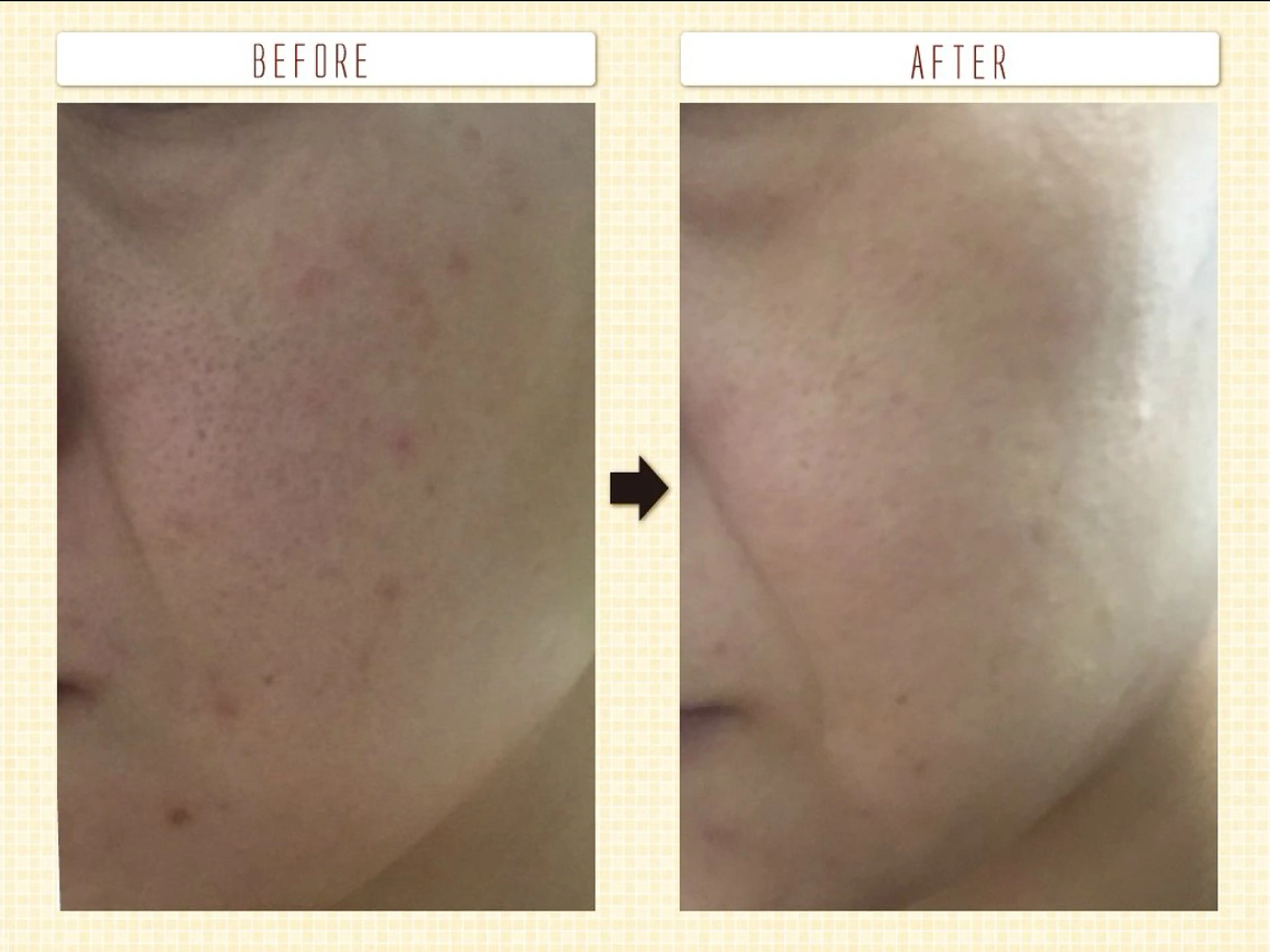 その他 たるみ改善小顔エステ 堀葉月のその他イメージ