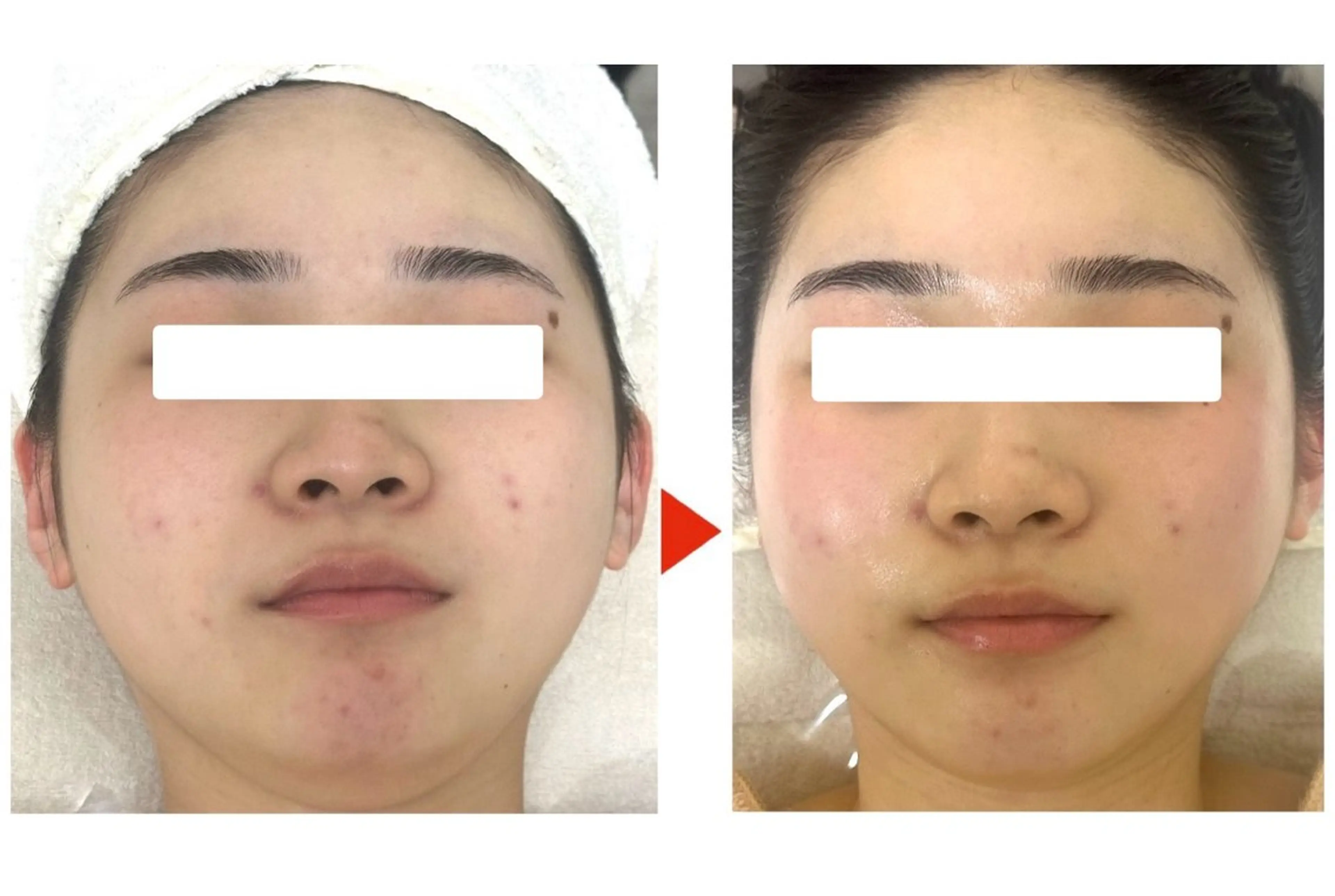 ❤️✨ニキビ対策緊急対策❤️ダブルパックで徹底保湿&顔ダニ除去でニキビ対策60分コース‼️デコルテ、顔リンパマッサージ有の写真