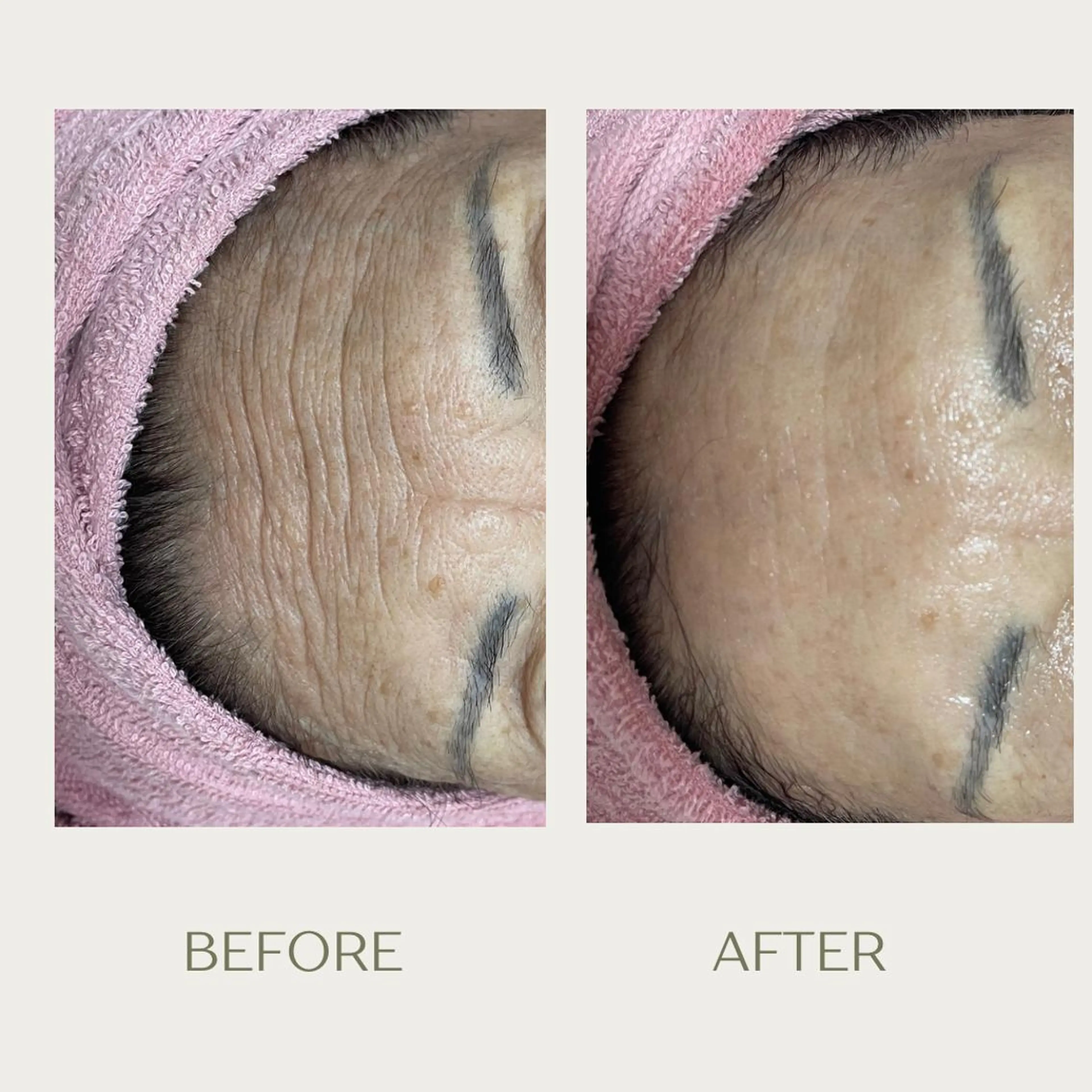 ピーリングケア 🤍moekoのエステ・リラクイメージ