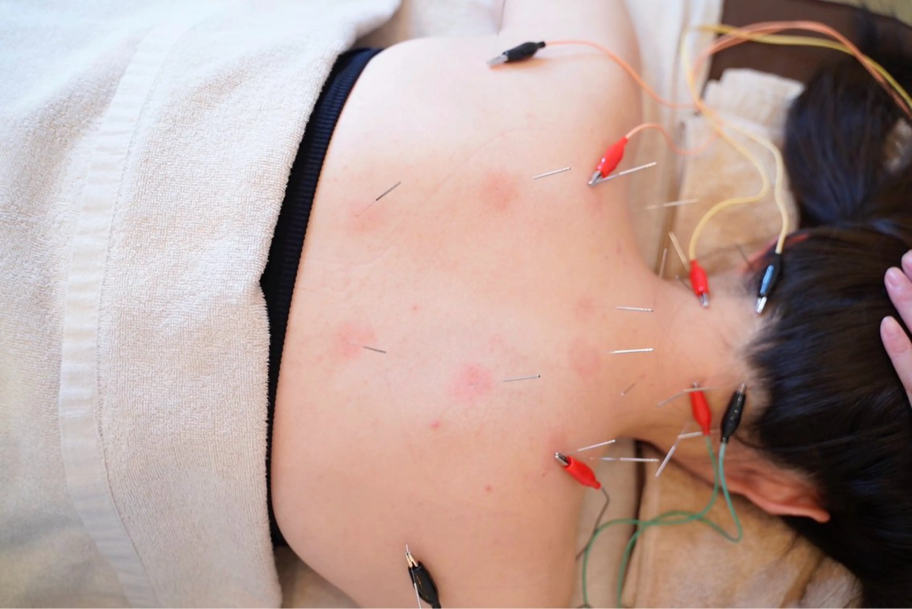 人気小顔美容鍼✨＋首肩の鍼🪡の写真