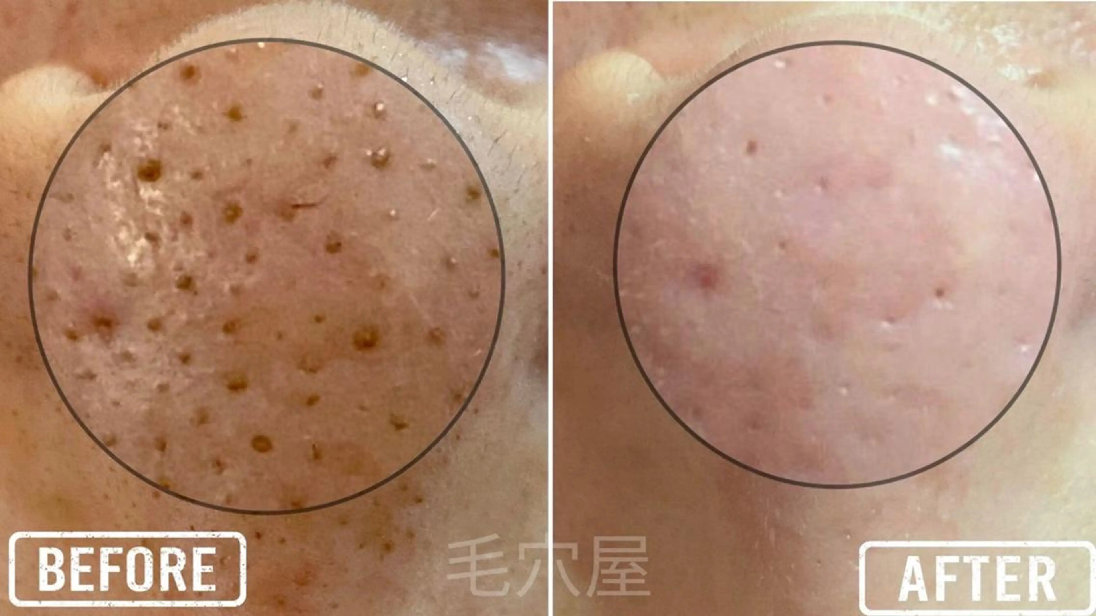 【毛穴洗浄】全顔ツルツル☆毛穴洗浄マシーン全顔＋毛穴ハンド技術毛穴汚れす/毛穴角栓取りの写真