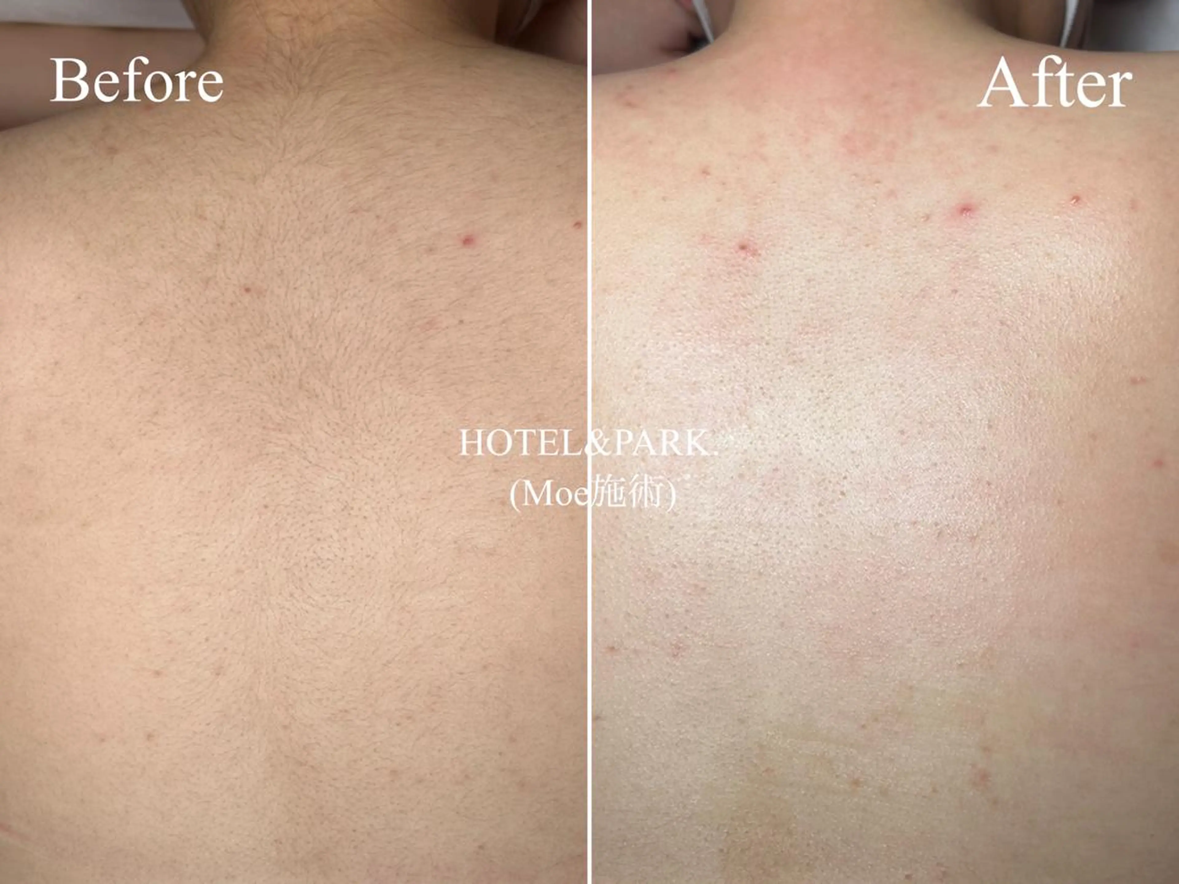 HOTEL&PARK . ワックス脱毛のエステ・リラクイメージ