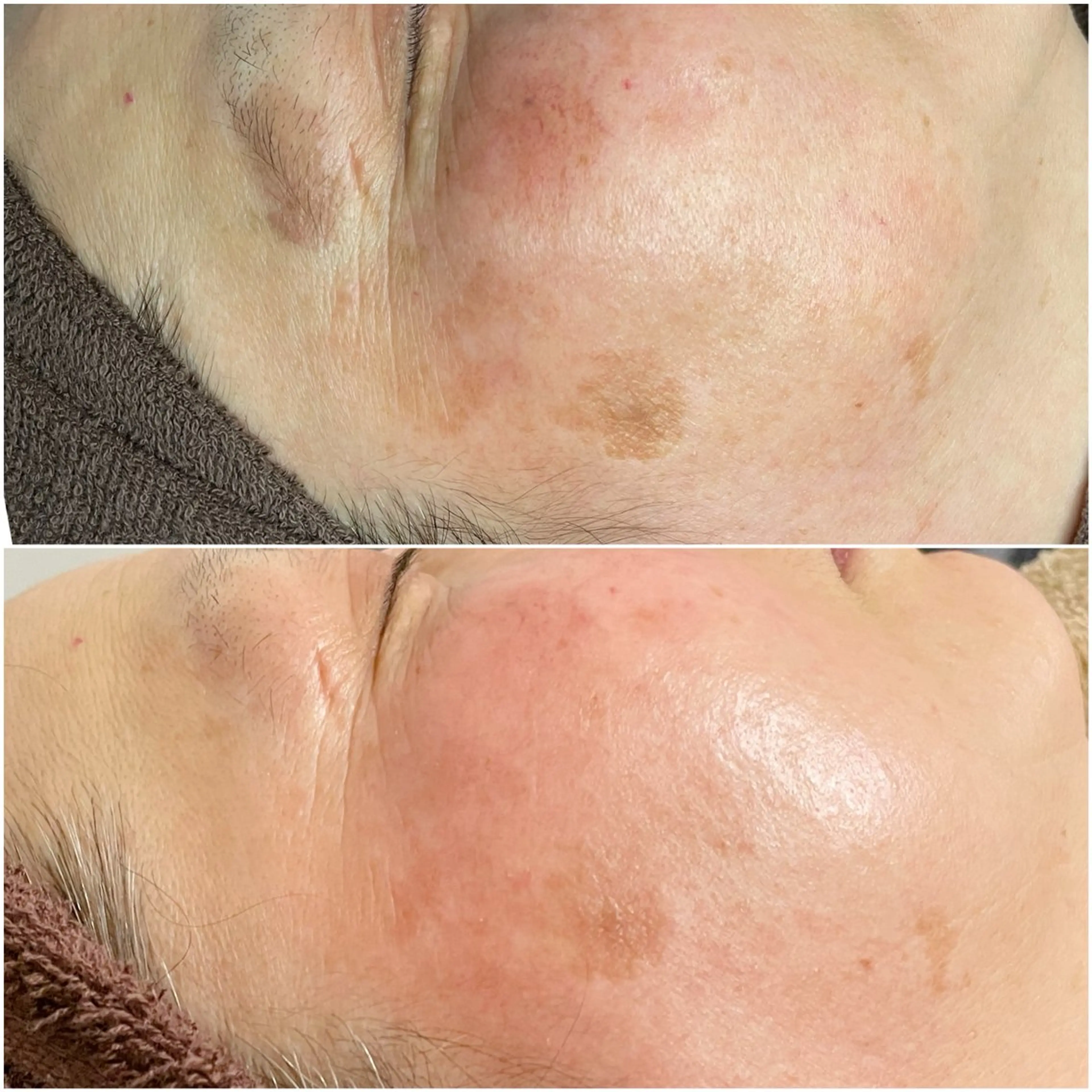 《くすみケア》プラズマニア施術の写真