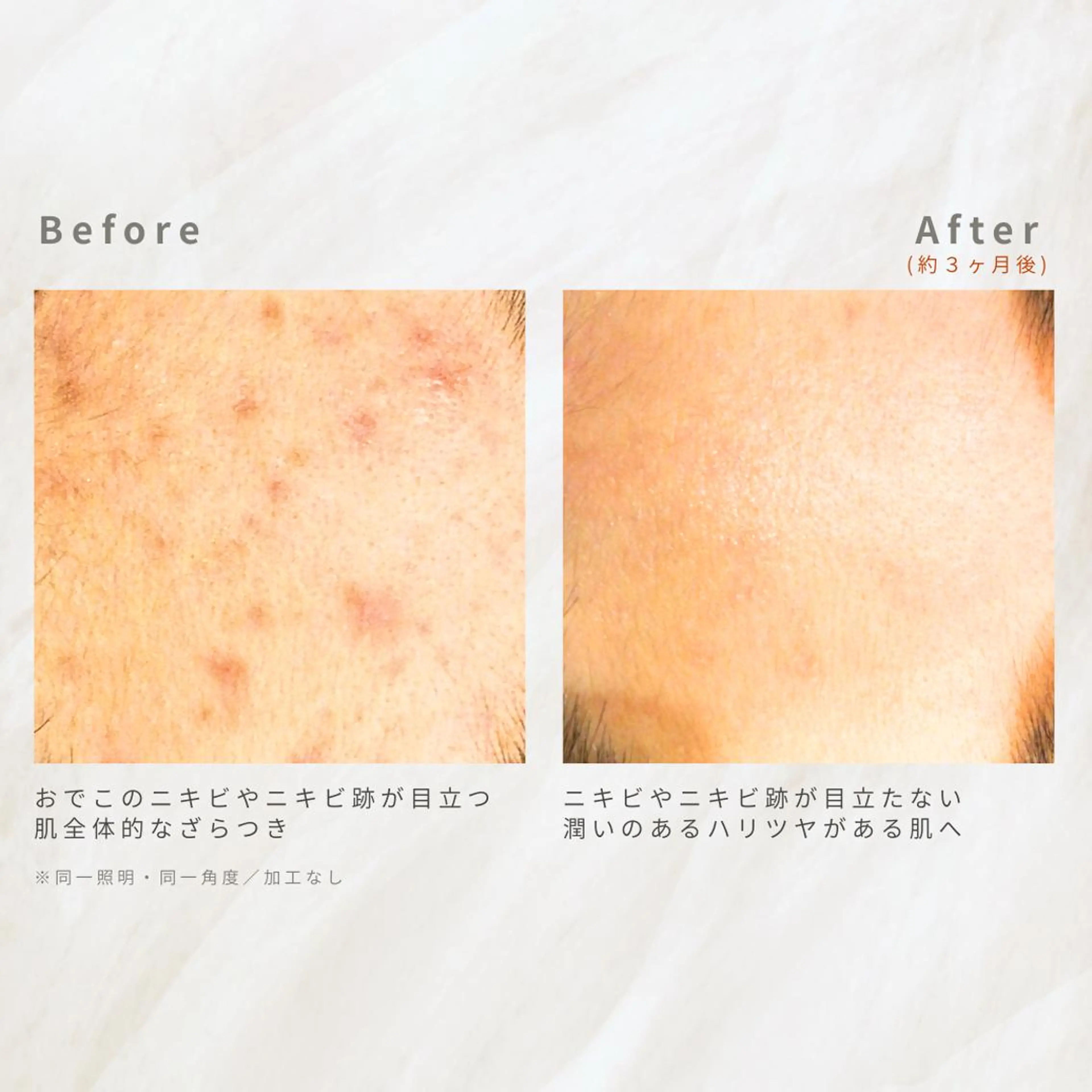 繰り返すニキビを改善 ✨つくば肌質改善専門のエステ・リラクイメージ