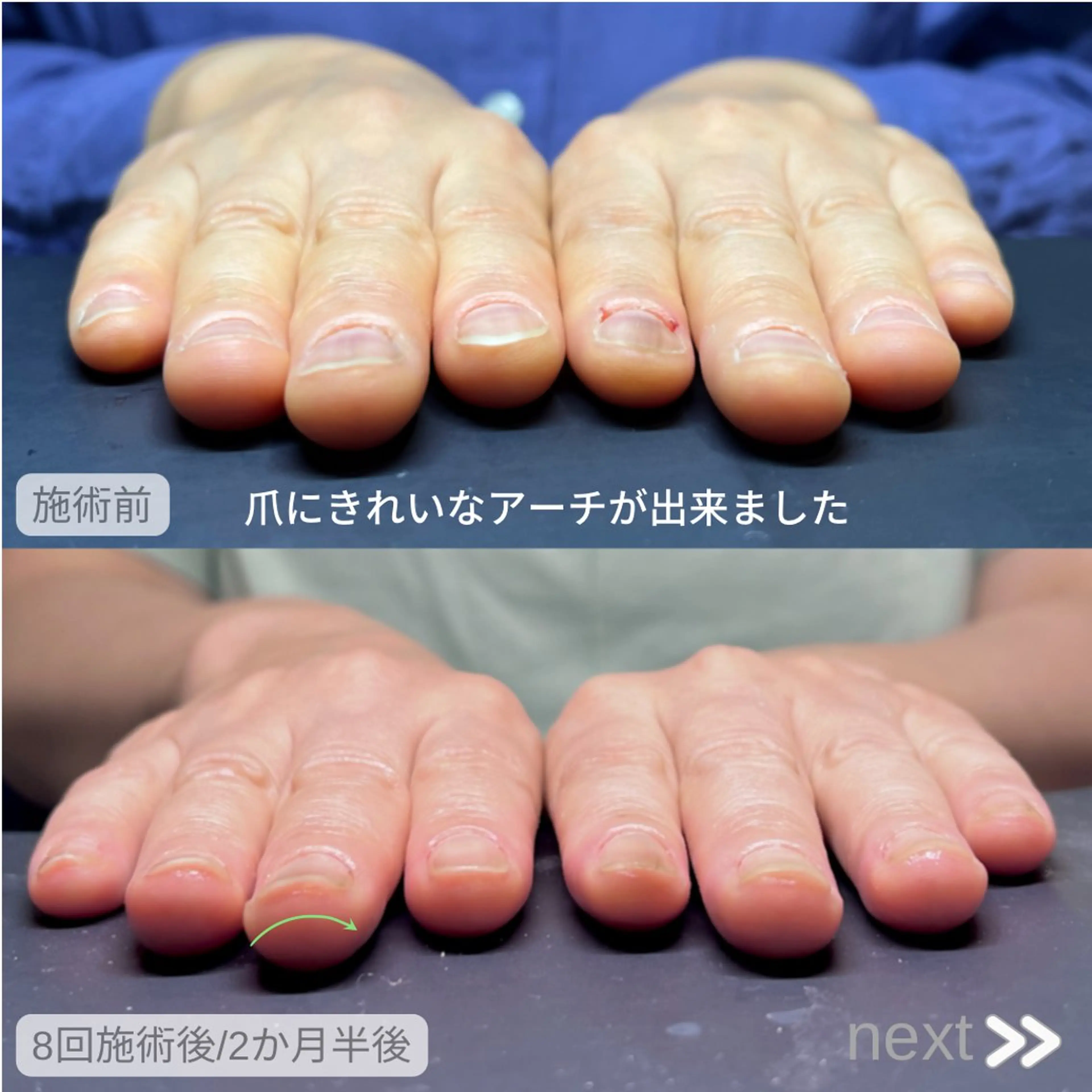 【自信のもてる手に✨】自分でケアできる！深爪・噛み爪ケア8回コース🧸の写真