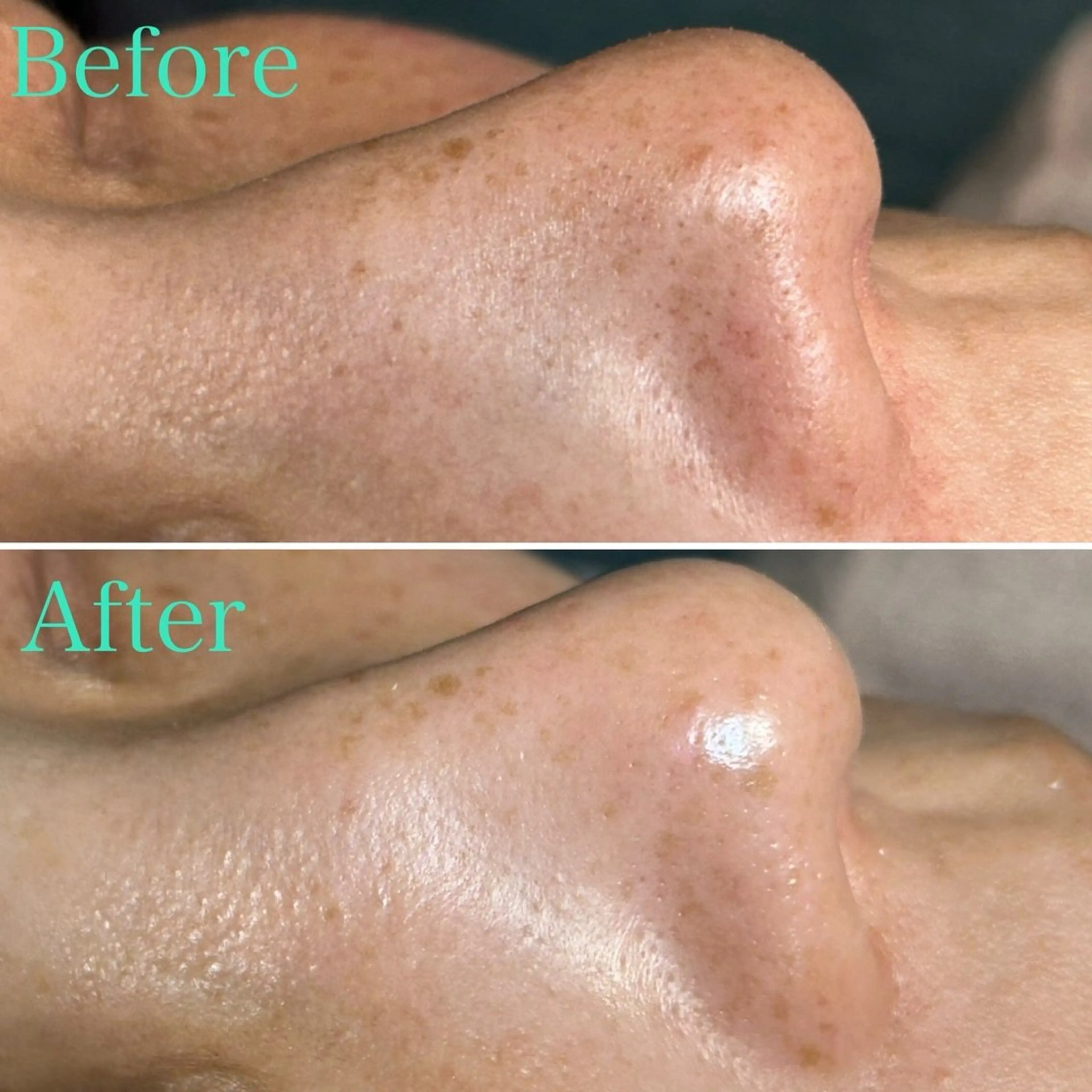 【モニター】毛穴洗浄のみの写真