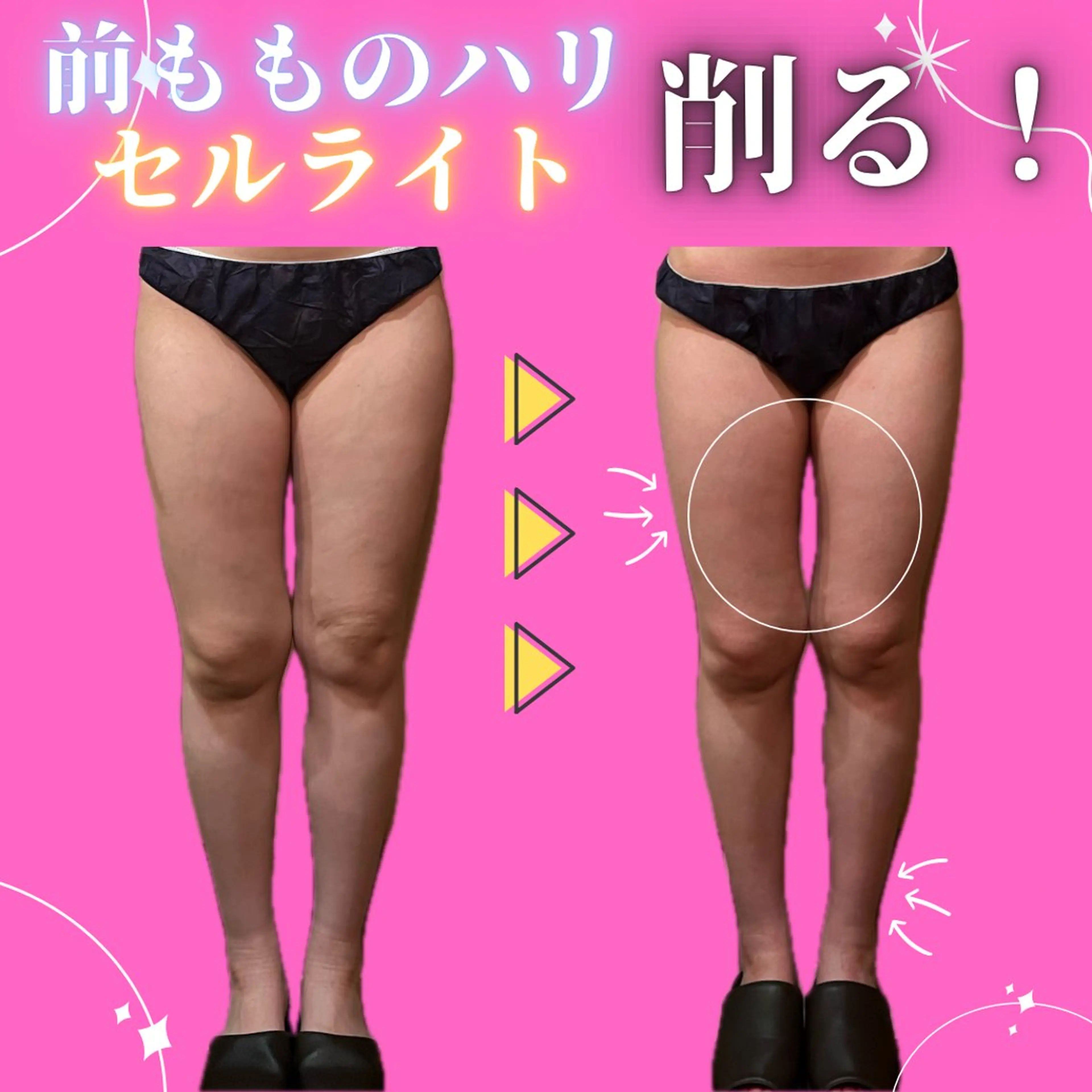 足痩せ人気No.1✨筋肉太り、むくみ、セルライト頑固な脂肪を必ず削ぎ落す🔥サイズダウンしながら痩せやすい身体に🐰ིྀの写真