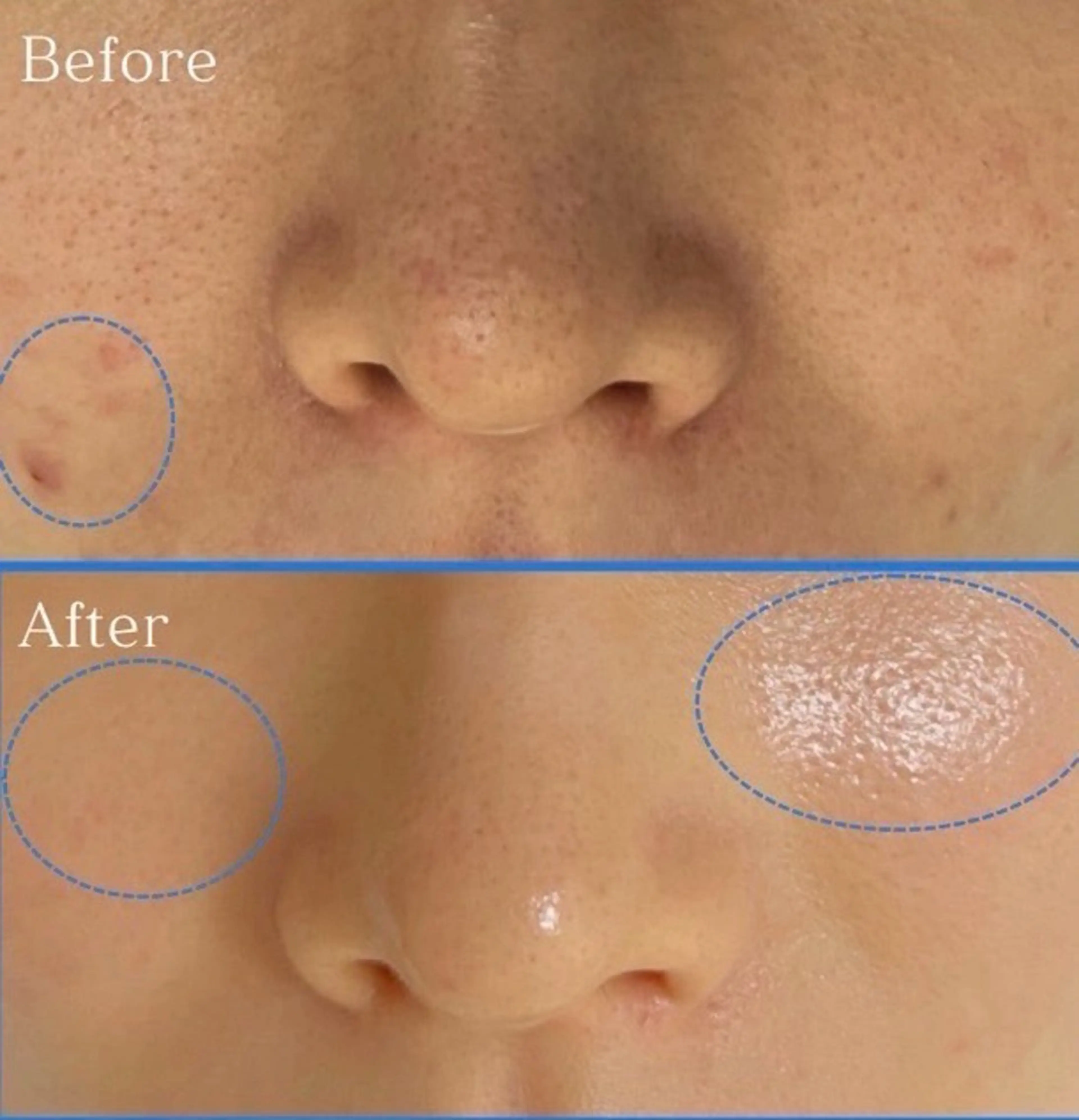 【最新・美肌ピール】毛穴・ツヤ・ハリ¥5500の写真