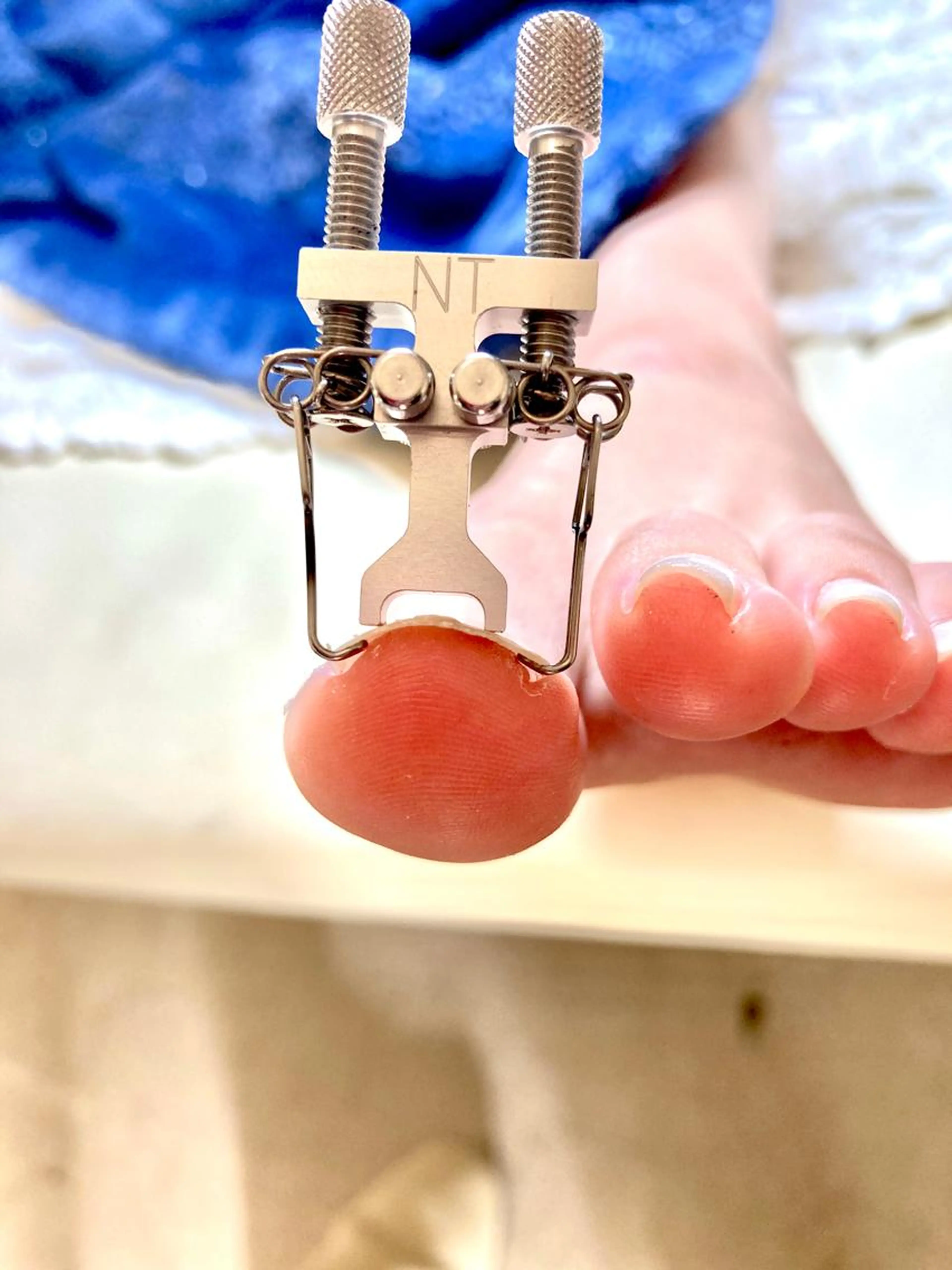 巻き爪ケア（1箇所）の写真