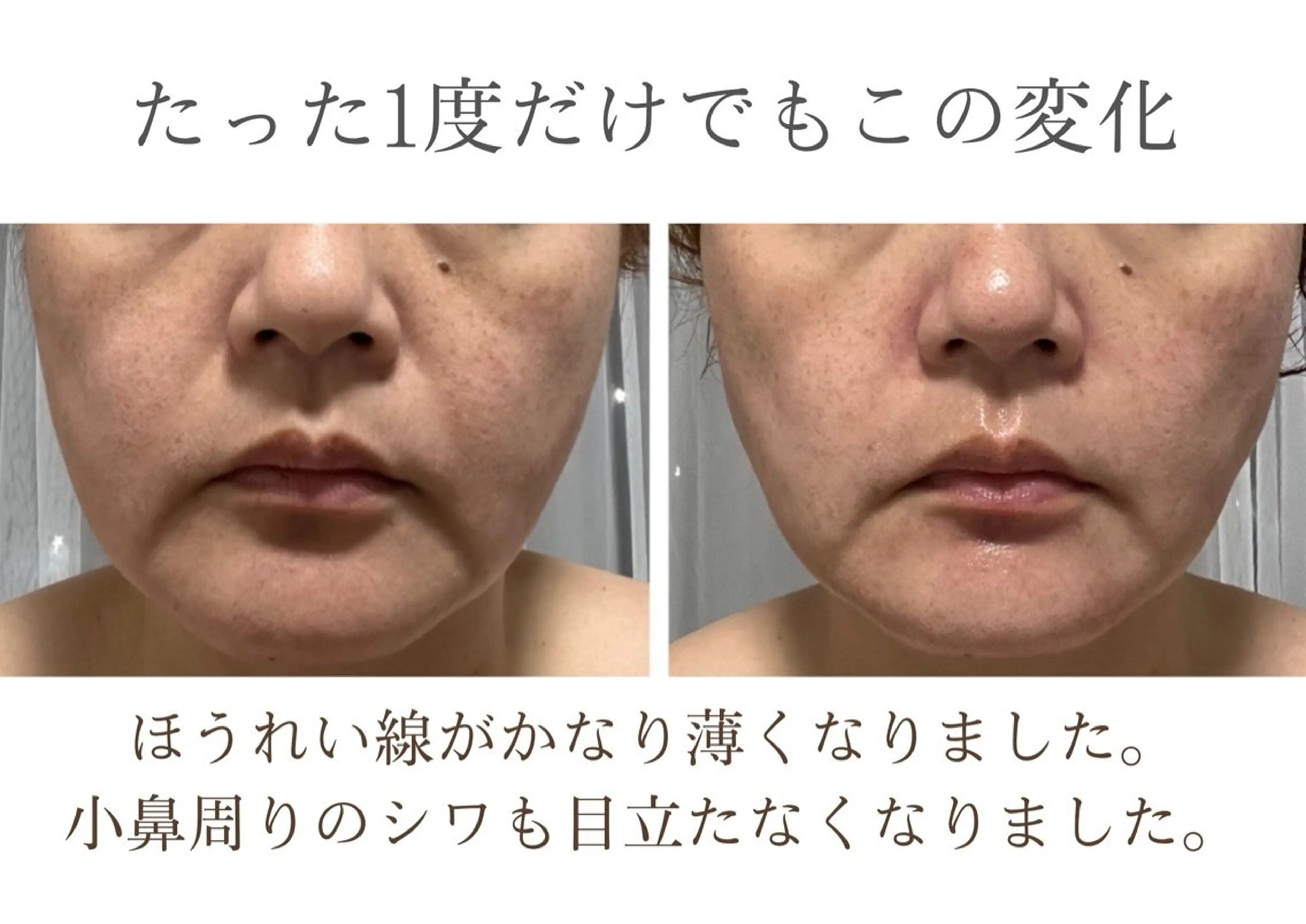 【結果重視】プレミアム幹細胞美容液導入☆しみ、しわ、美白改善コース体験💆‍♀️✨️の写真