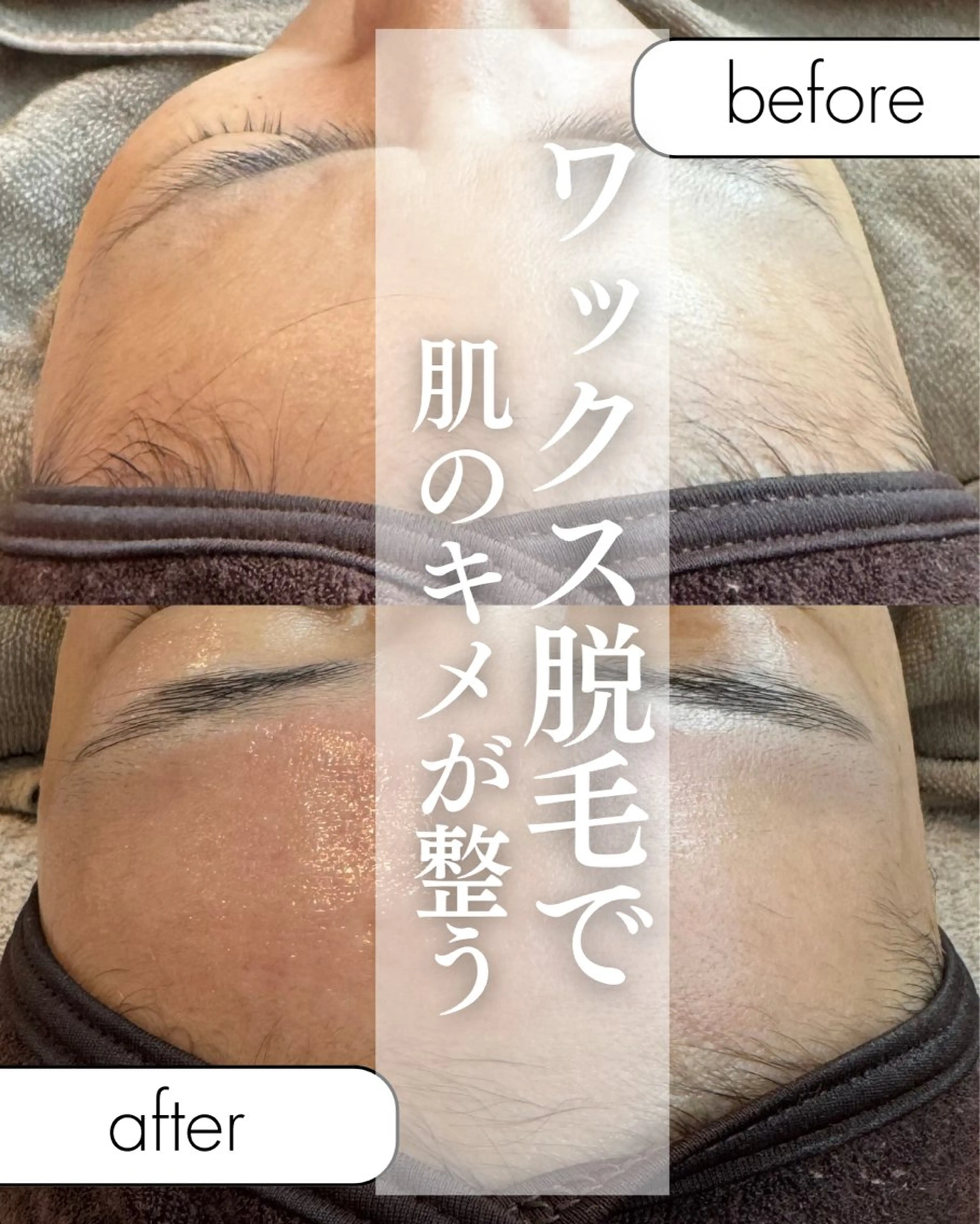 【ご新規様価格】美肌へ導く✨フェイシャルワックス脱毛の写真