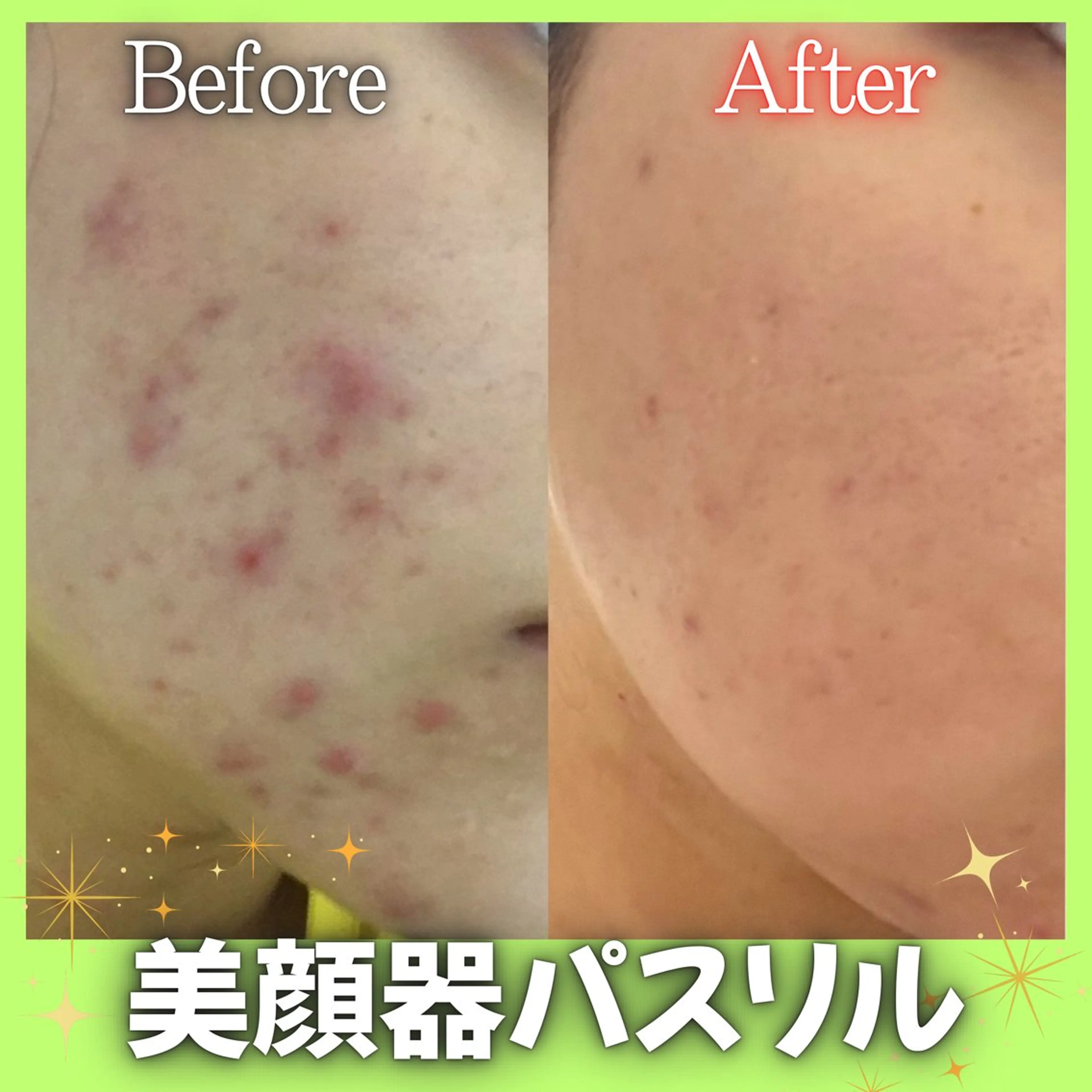 【パスリル購入希望者限定】新美顔器パスリルリュクス体験✨たった5分で-3㎏小顔・美肌に導く美顔器🕊️の写真