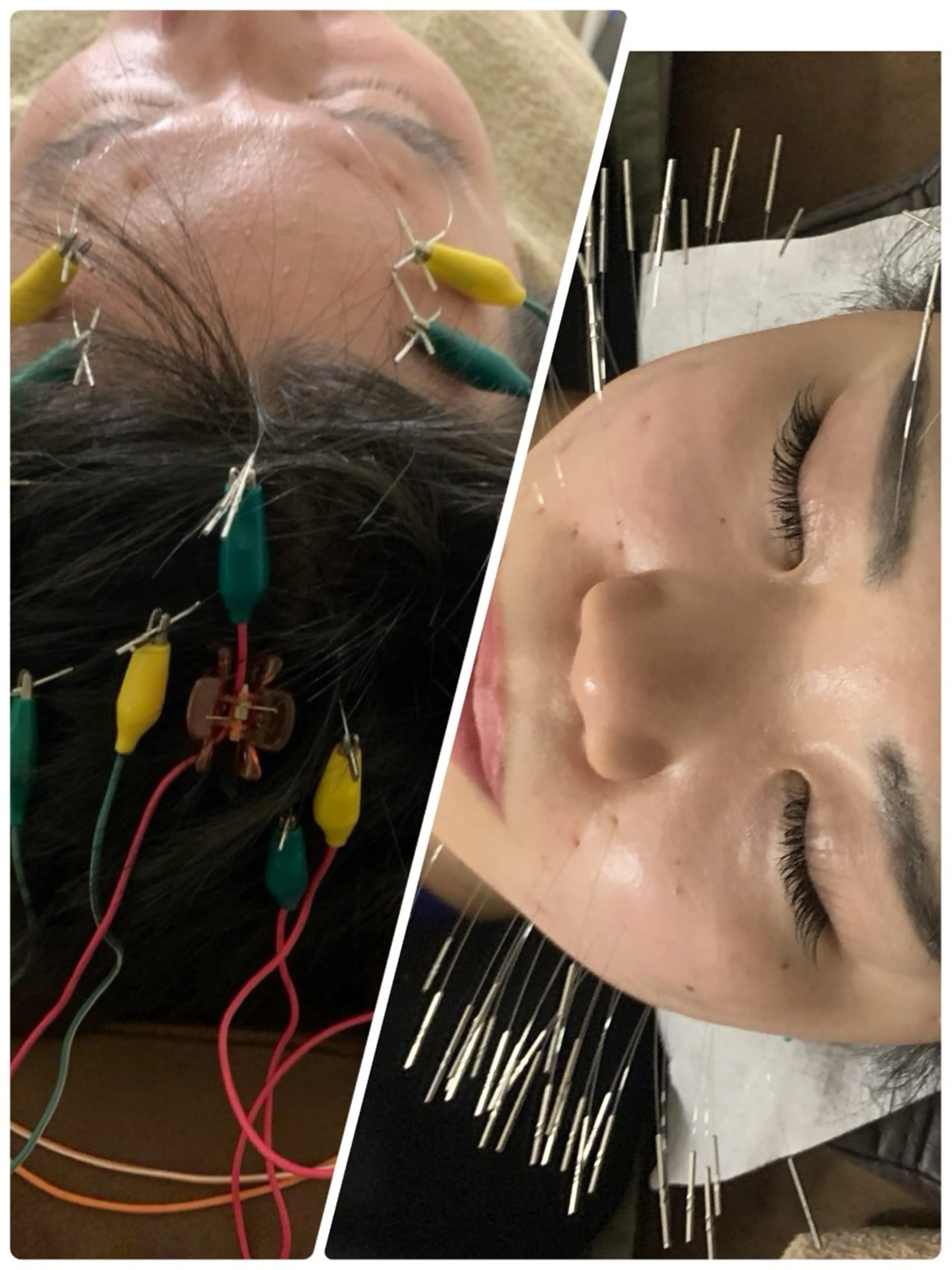 表参道鍼灸院K 美容鍼🔮ララピールのエステ・リラクイメージ