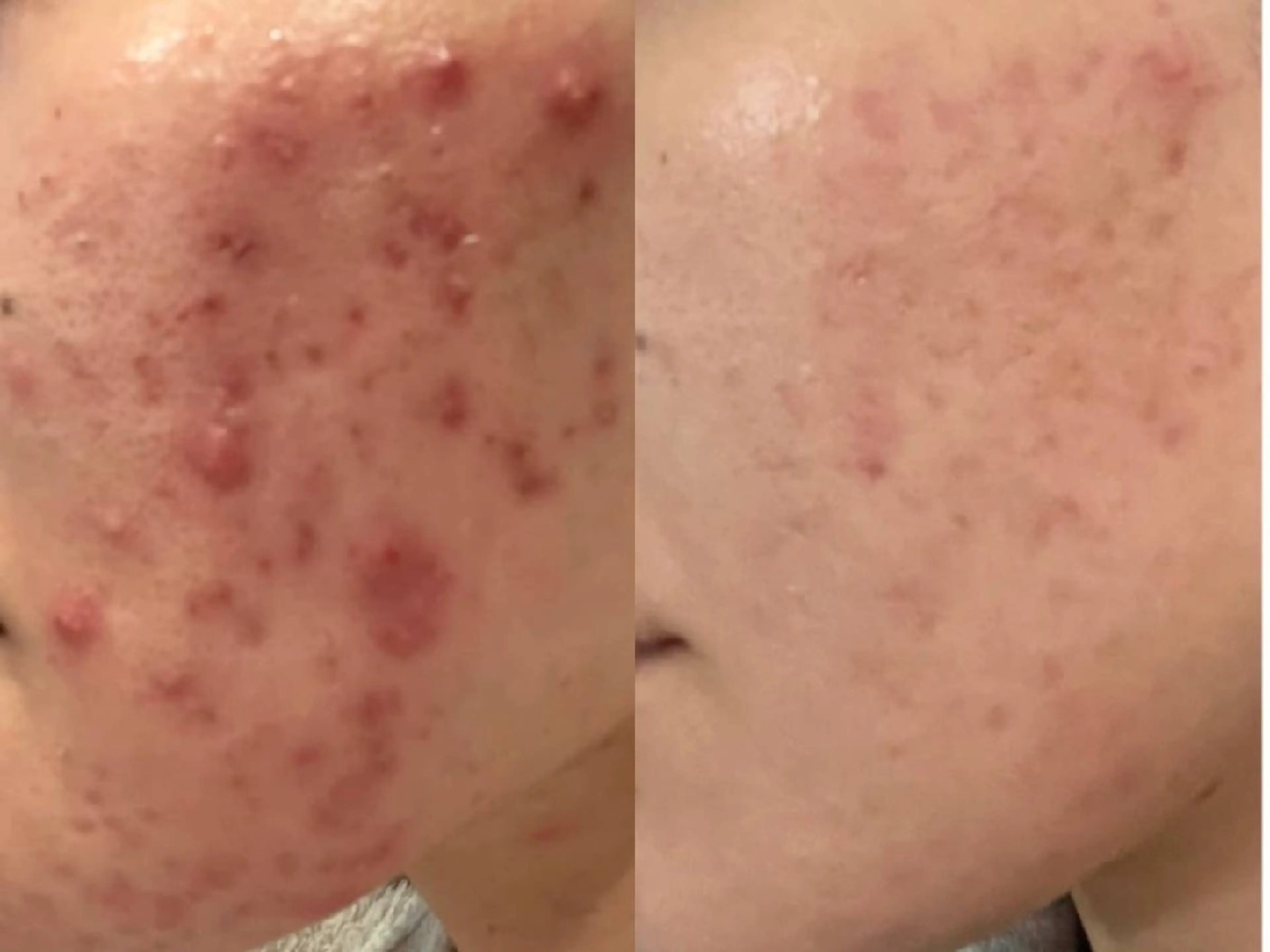 ハーブピーリング【選べる剥離】の写真