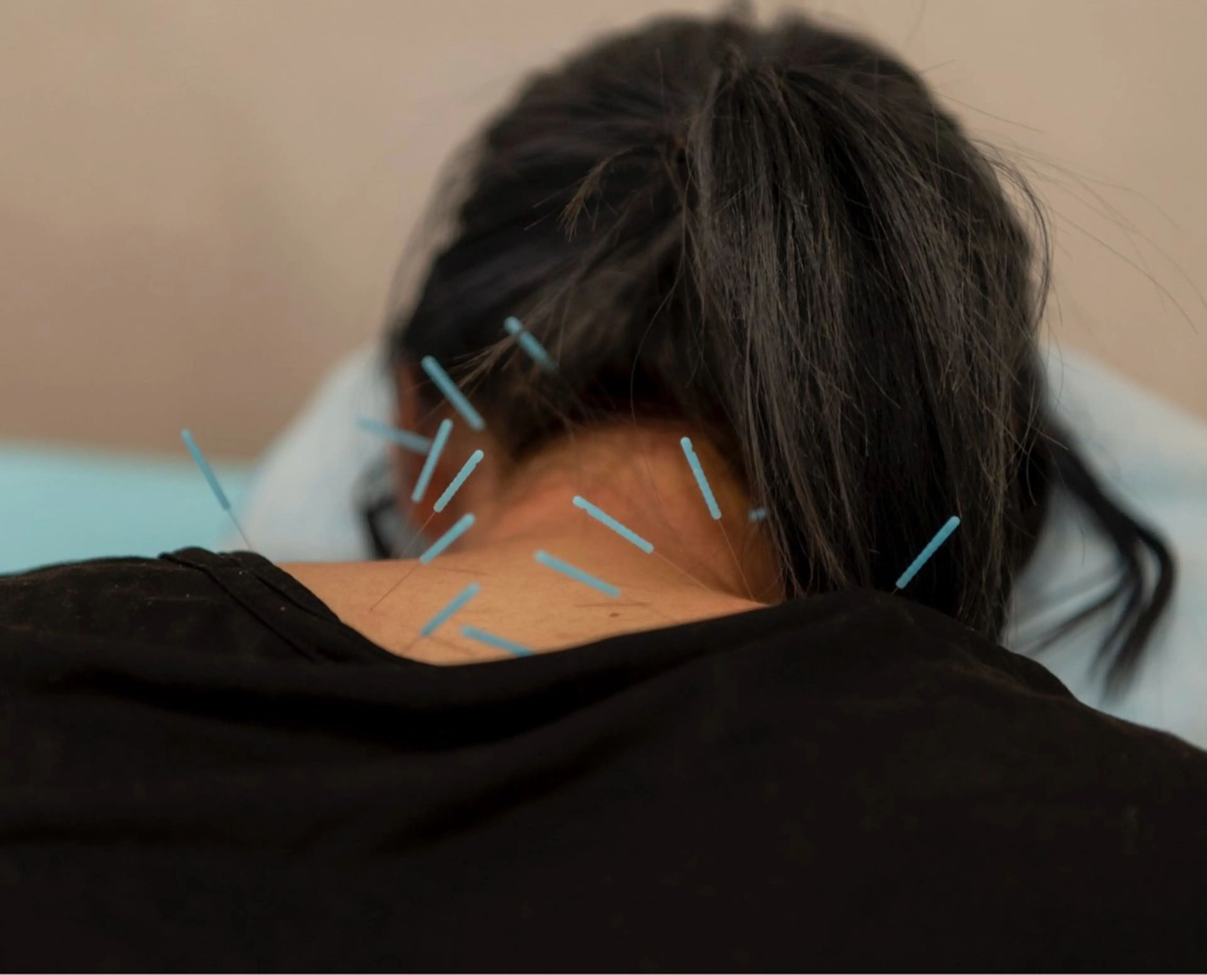 【首肩腰の慢性痛に⚡️】鍼施術60分（カウンセリング付きの写真