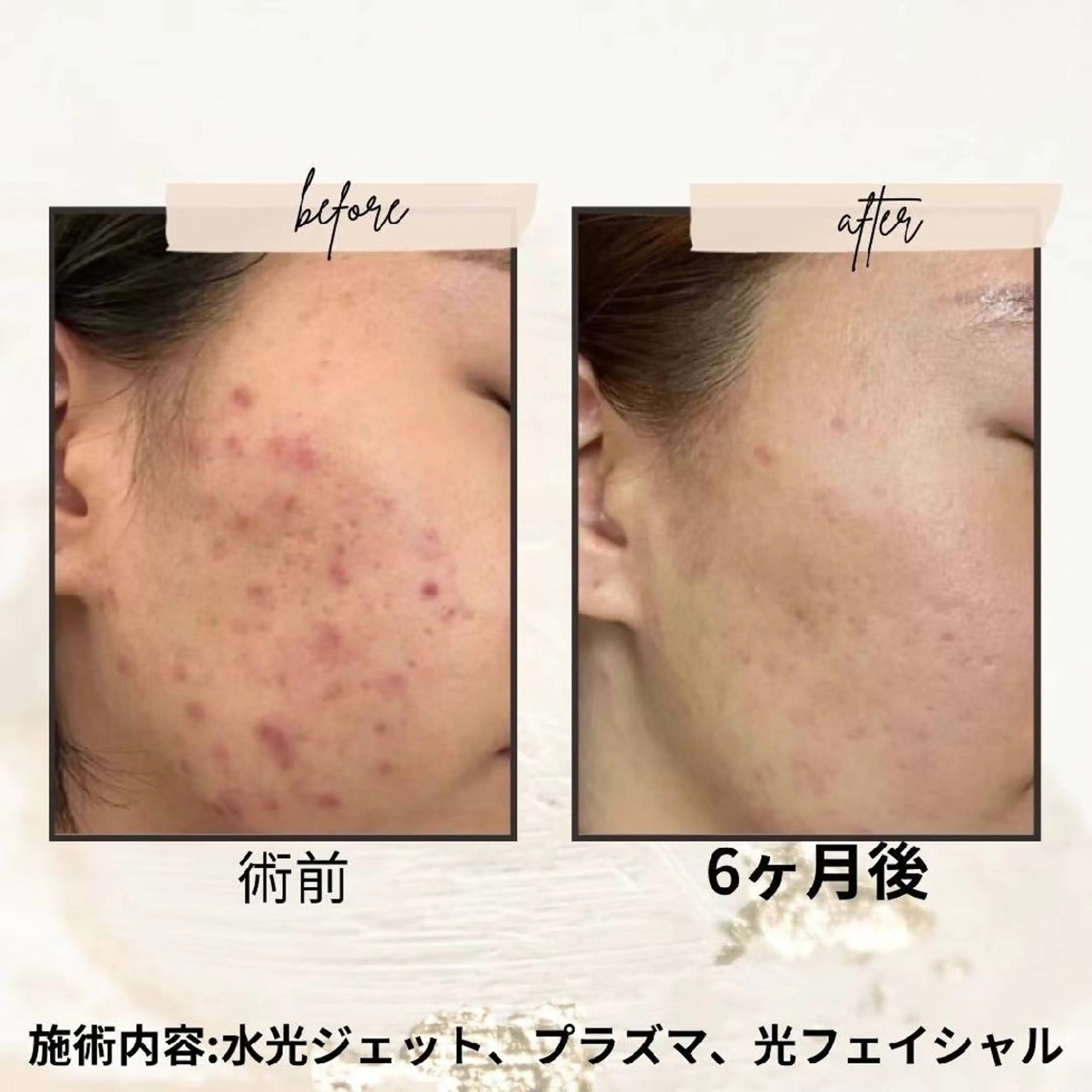 ネイル ブライダルネイル aliaハイフ&水光ジェットサロン所属・aliaハーブ水光店 エステティシャン募集のエステ・リラクイメージ