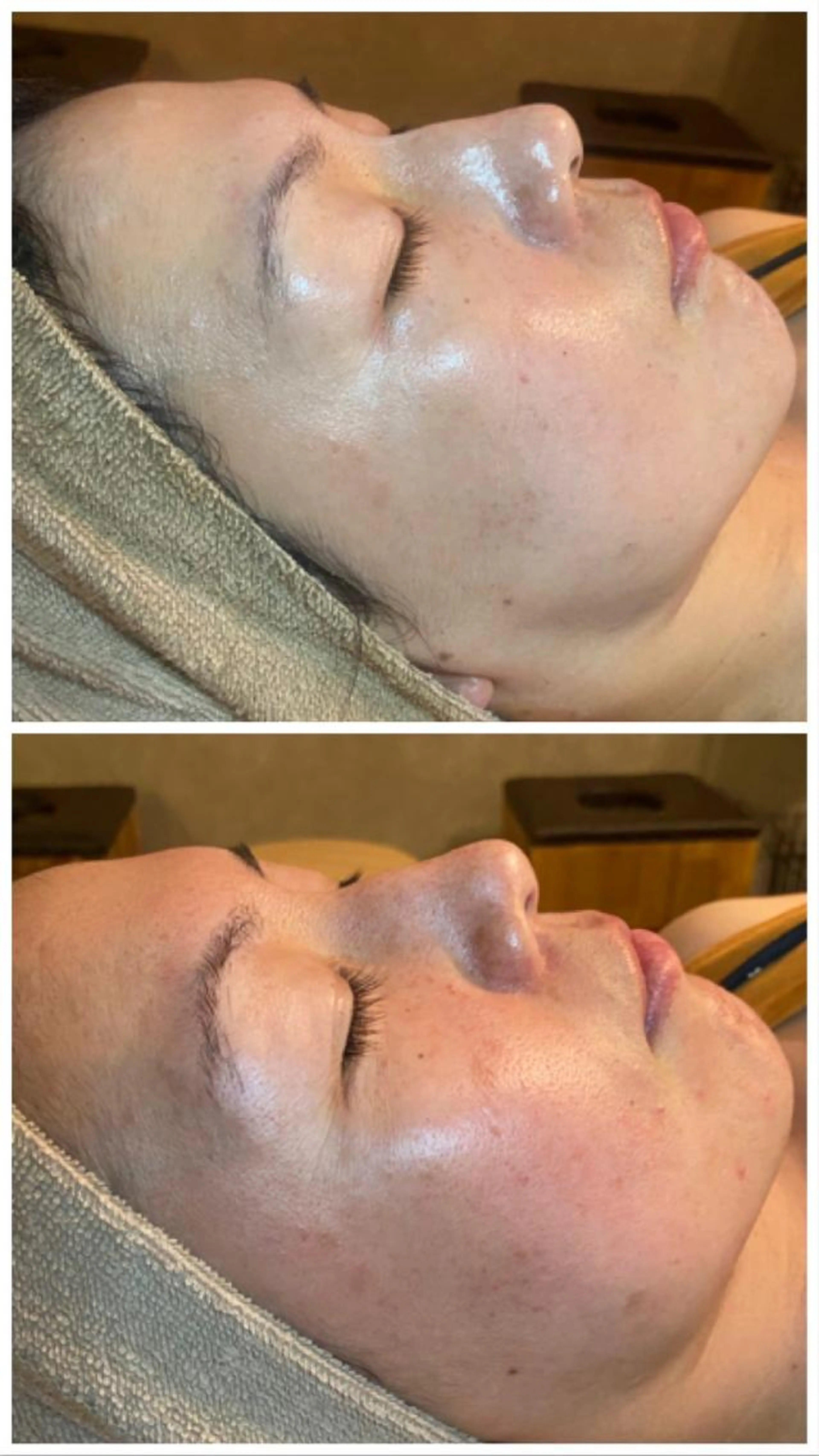 REVI陶肌トリートメント［ハーブピーリング］の写真