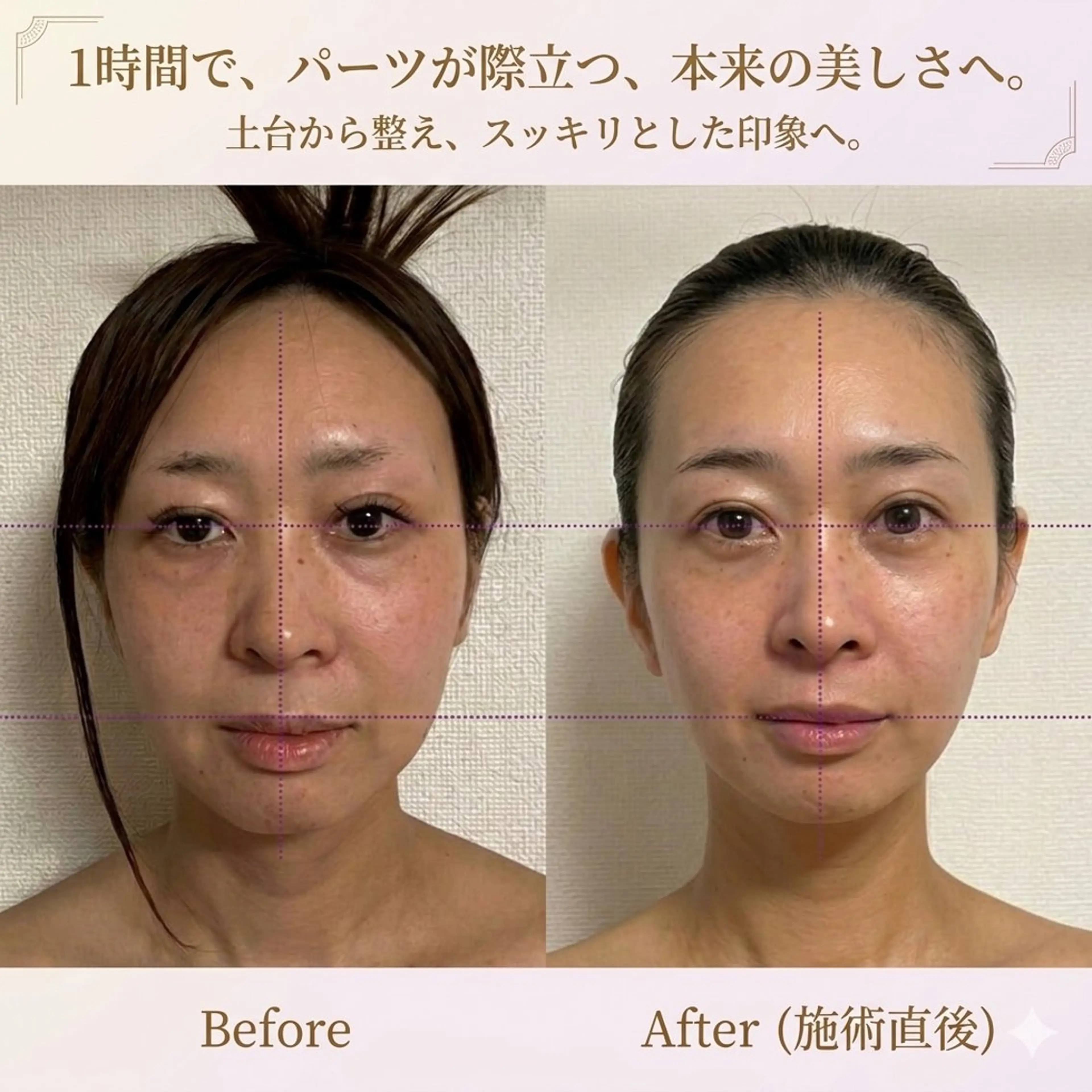 【姿勢×バストまわりケア✨】IW波で背中から整える✨本格フェイシャル×デコルテケアでうる肌＆首肩スッキリ♡の写真