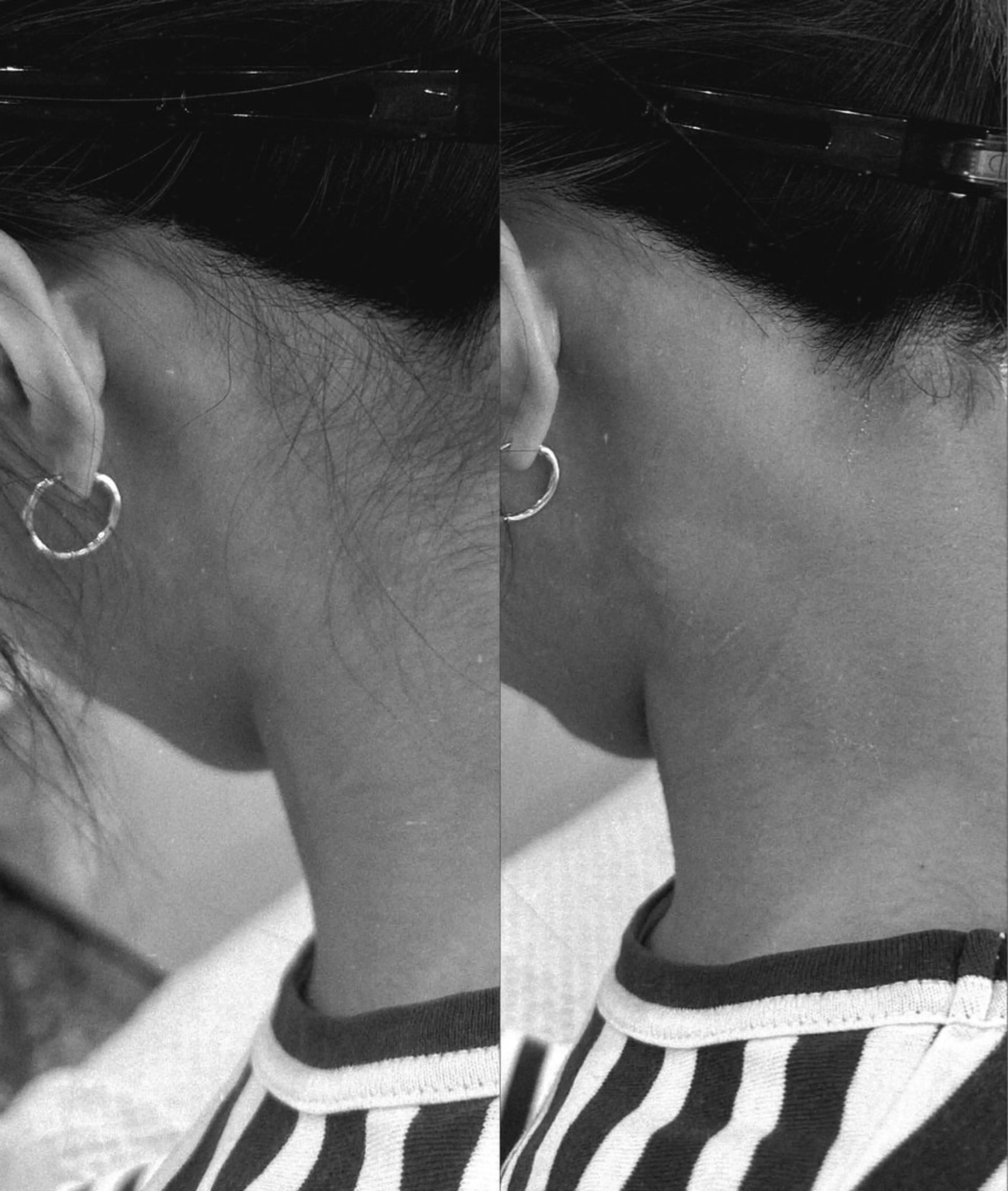 うなじW脱毛（ワックス＋光脱毛）の写真