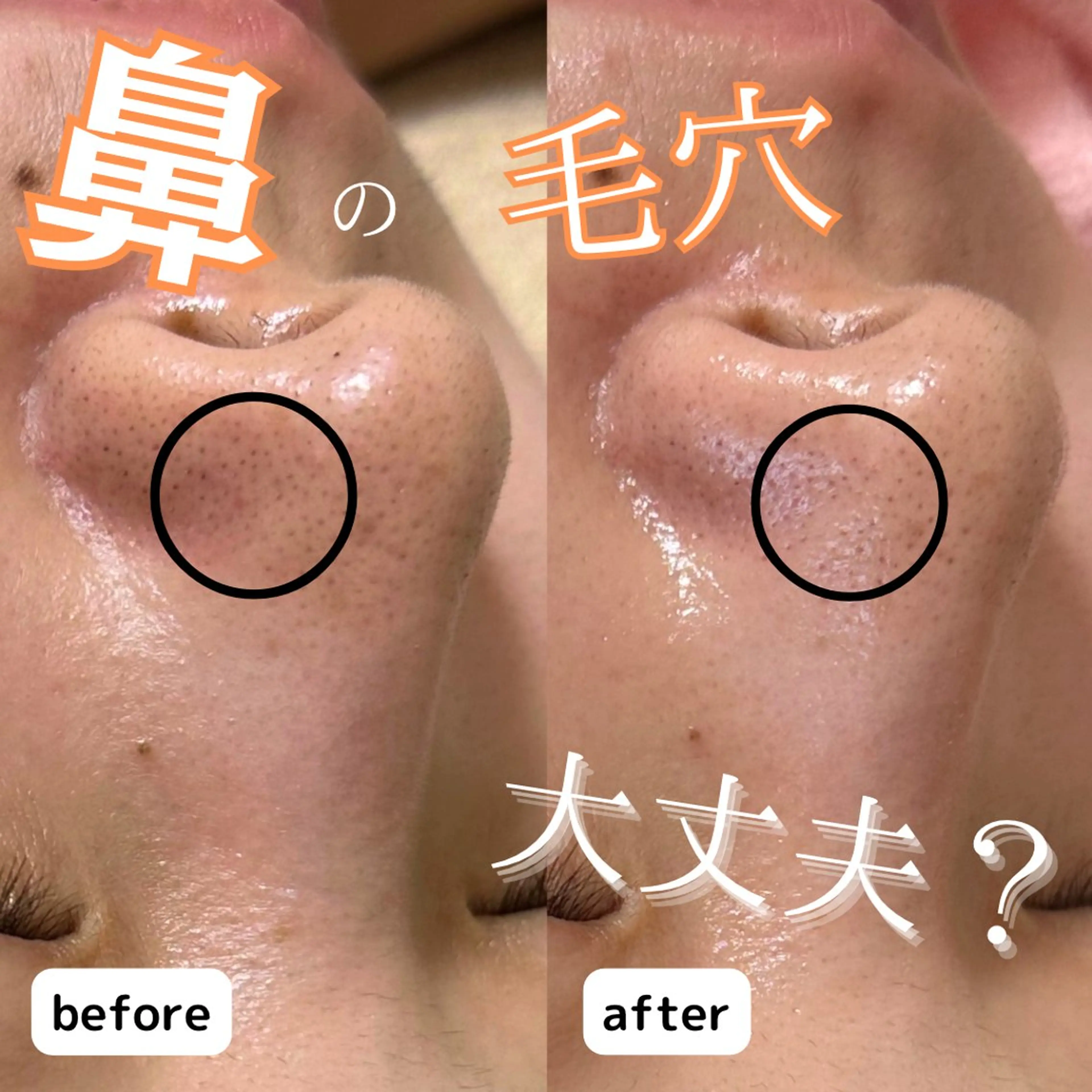 黒ずみ毛穴/ポツポツ毛穴/鼻の黒ずみ👃フェイシャル&デコルテ背中マッサージ込み🤍【角栓毛穴洗浄フェイシャル】の写真