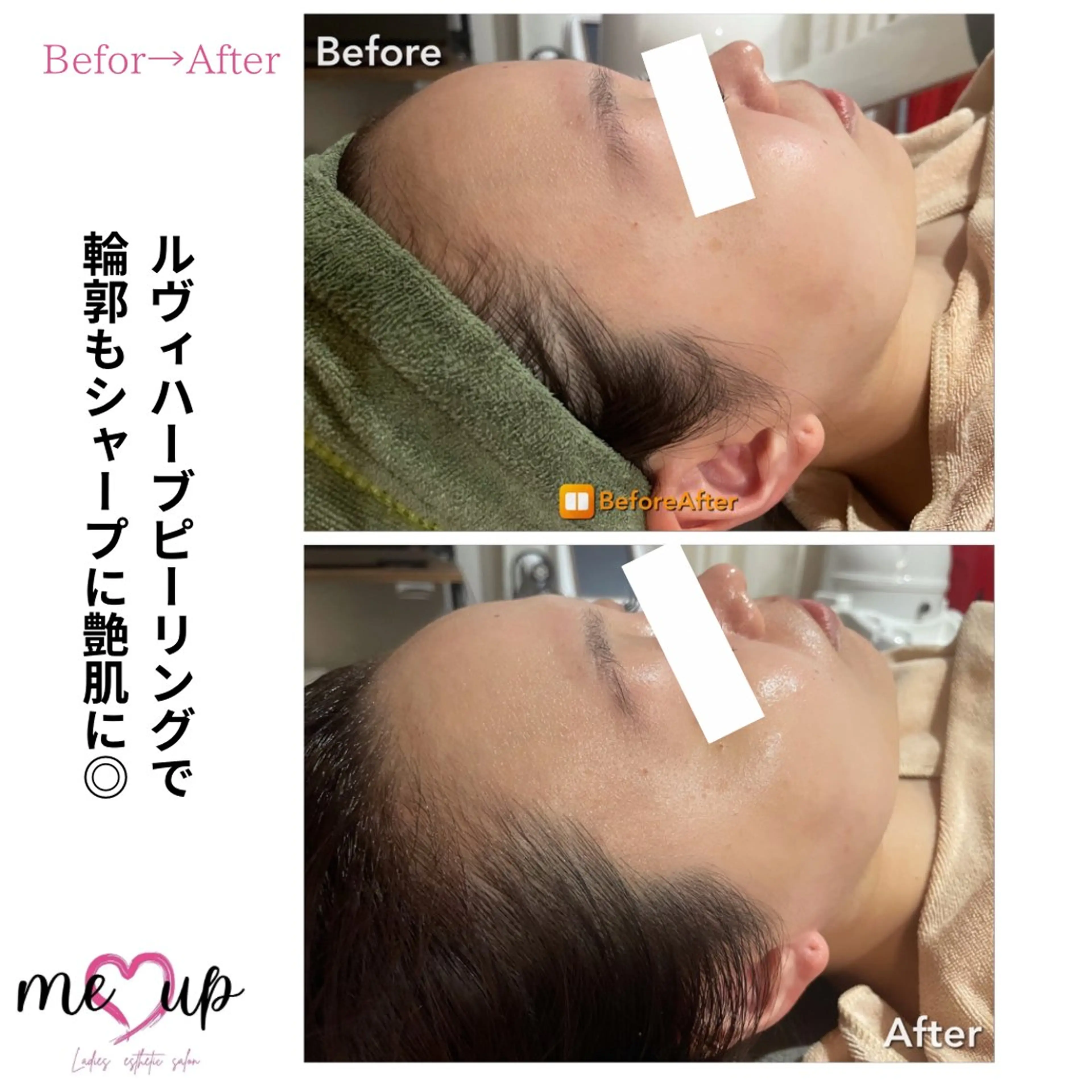 エステ Meupニキビ専門店 背中/ハーブ/肌管理のその他イメージ