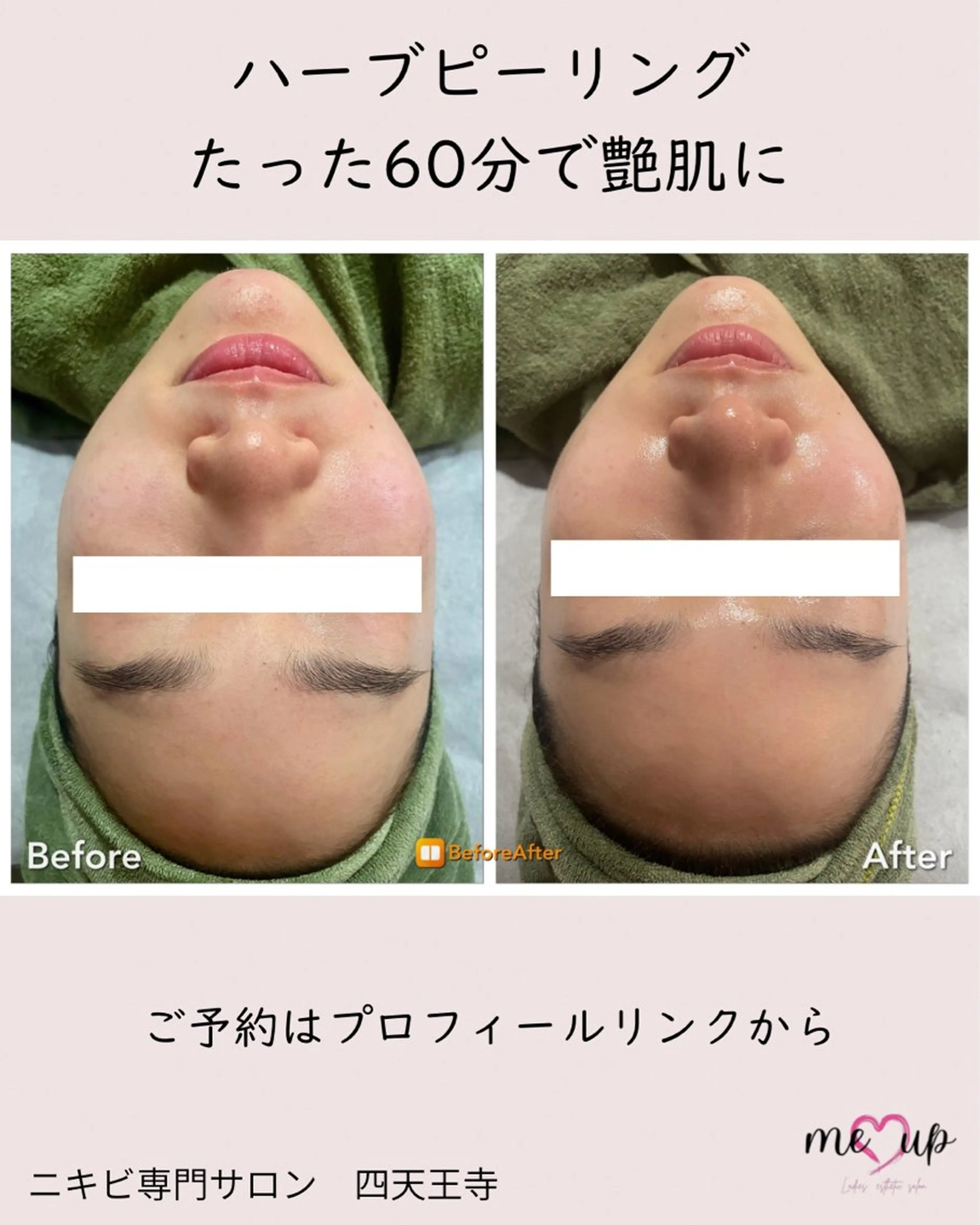 エステ Meupニキビ専門店 背中/ハーブ/肌管理のその他イメージ