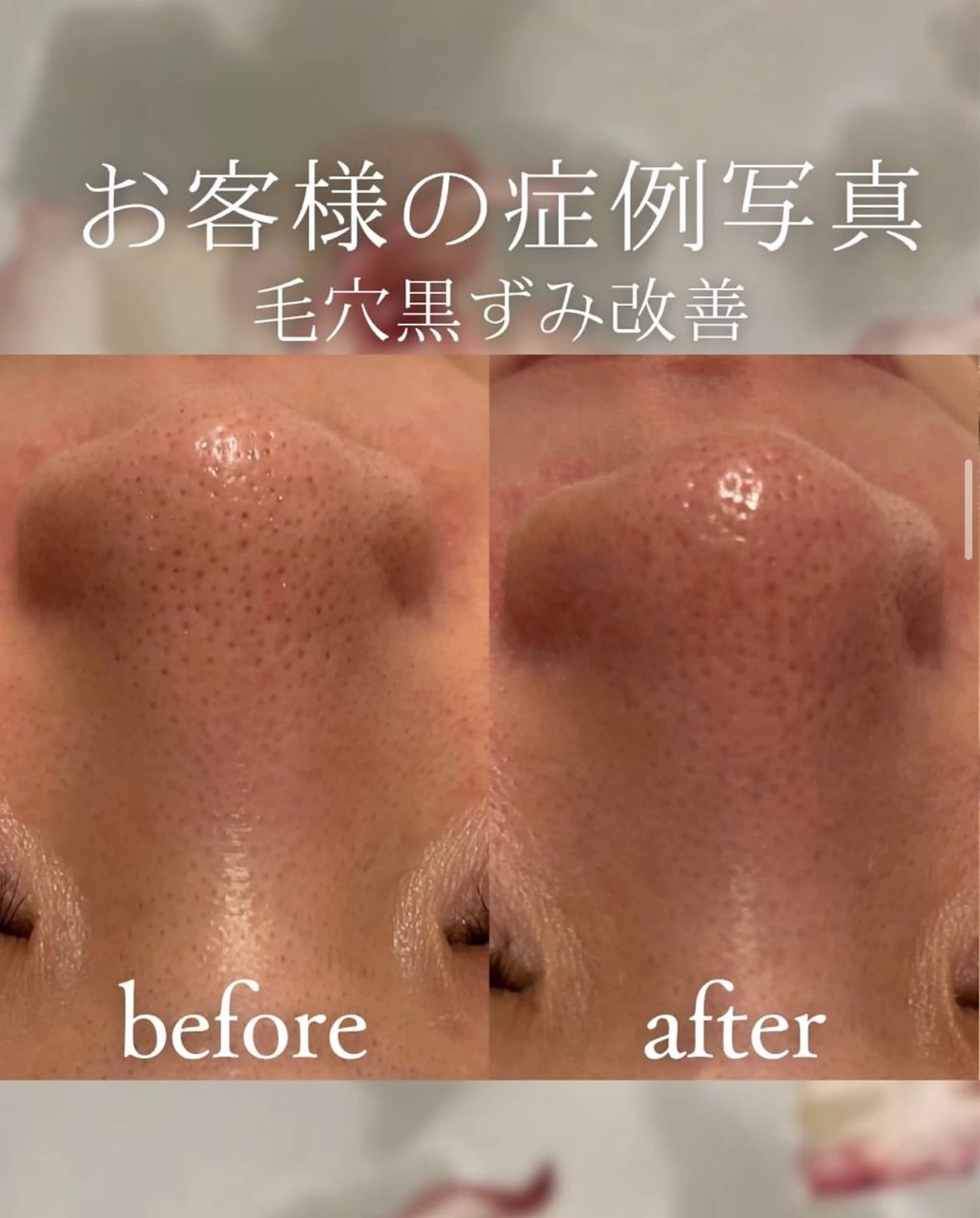 【毛穴黒ずみオフ】大人の毛穴悩みに!皮脂詰まり黒ずみ撃退🔥の写真