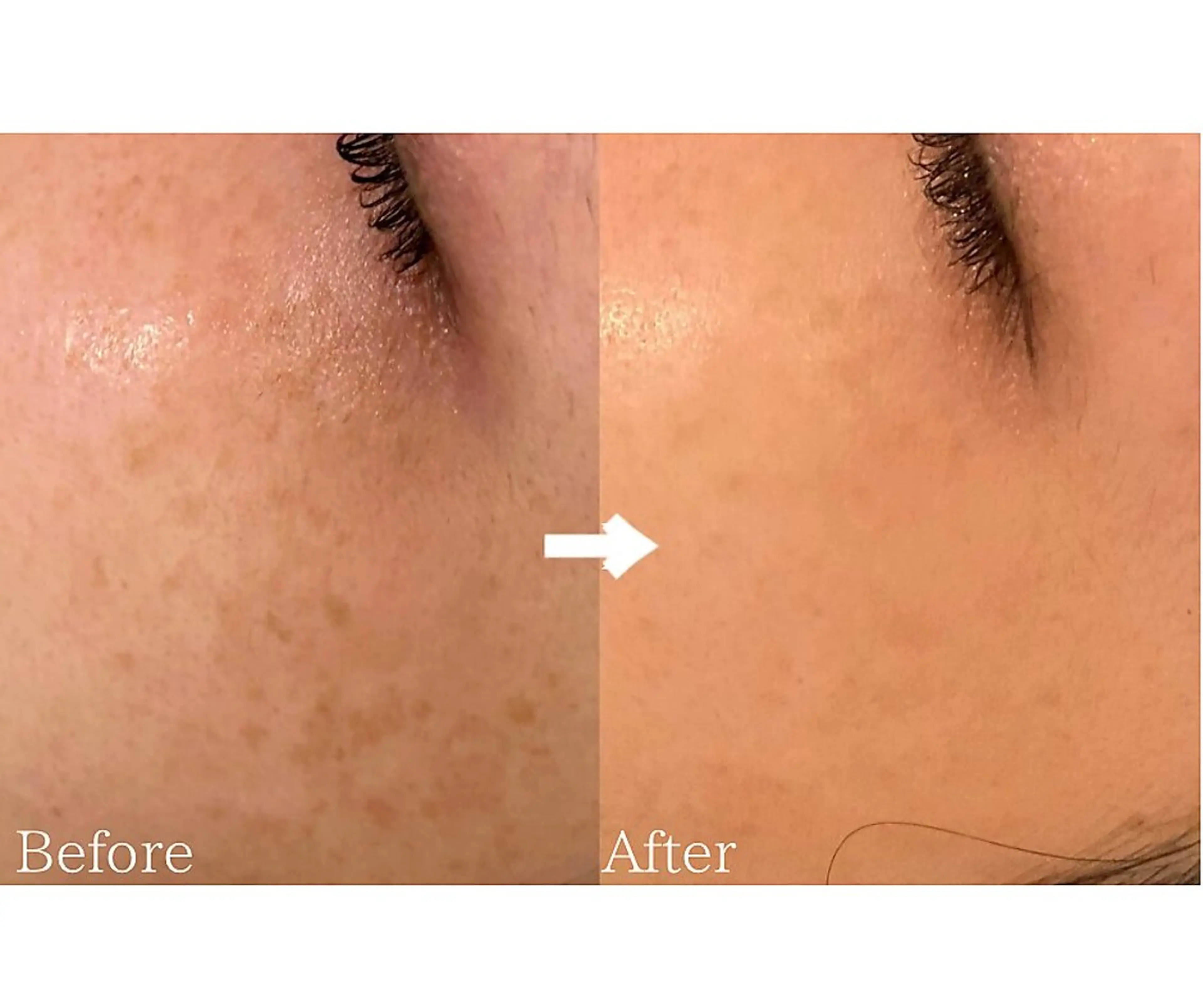 シミケア　気になるシミをピンポイントケアの写真